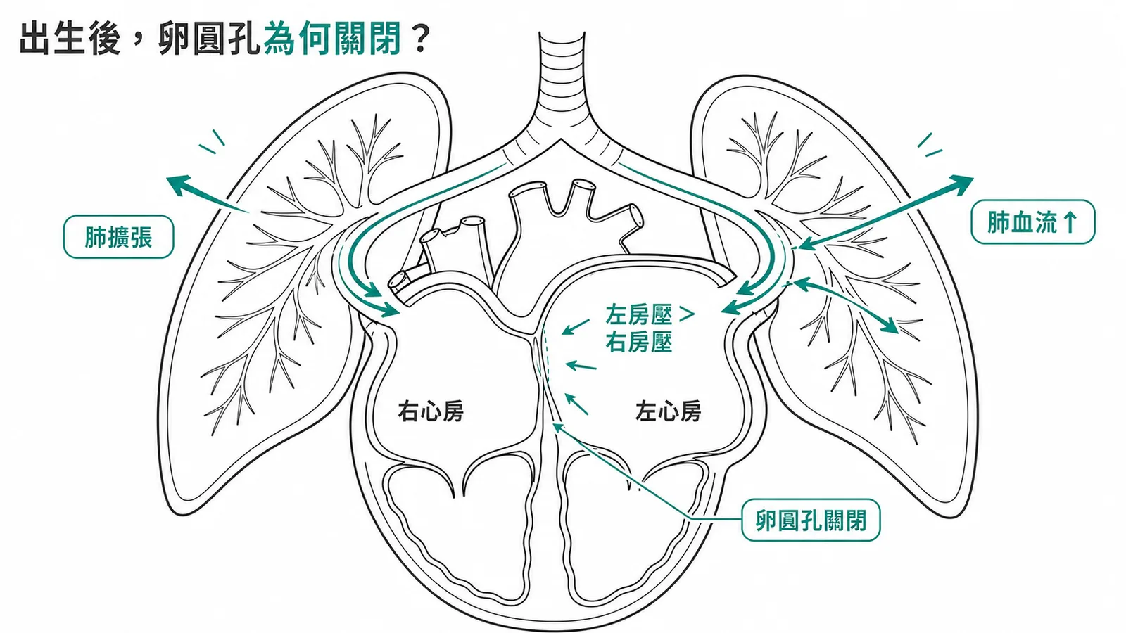 出生後肺擴張使肺血管阻力下降、肺血流上升，左房壓超過右房壓而關閉卵圓孔