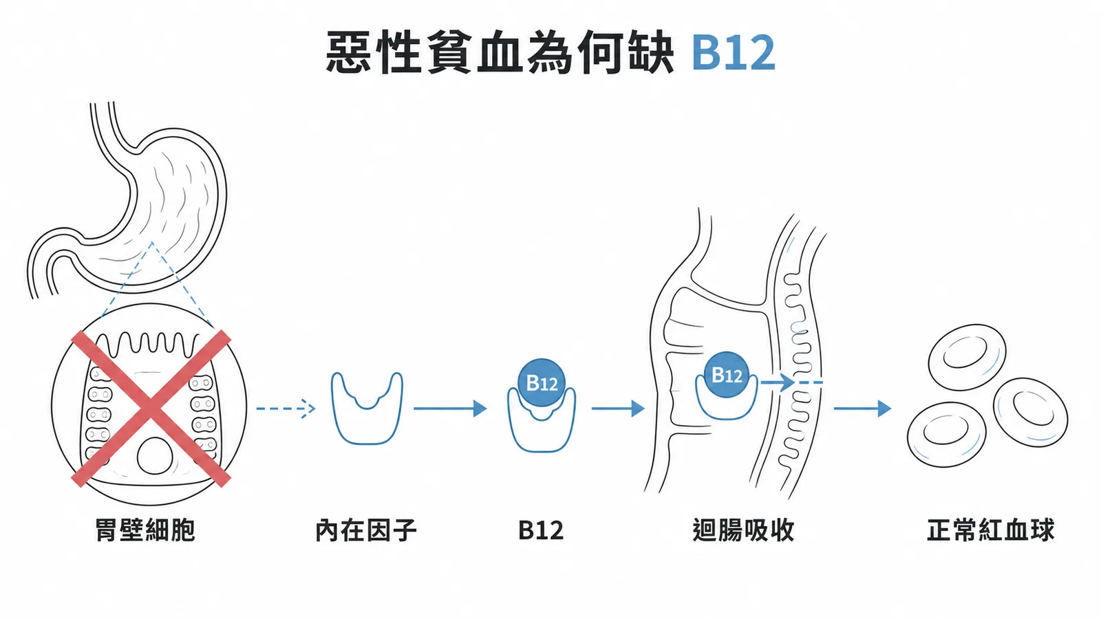 惡性貧血機轉：胃壁細胞受損導致內在因子缺乏使B12無法於迴腸吸收