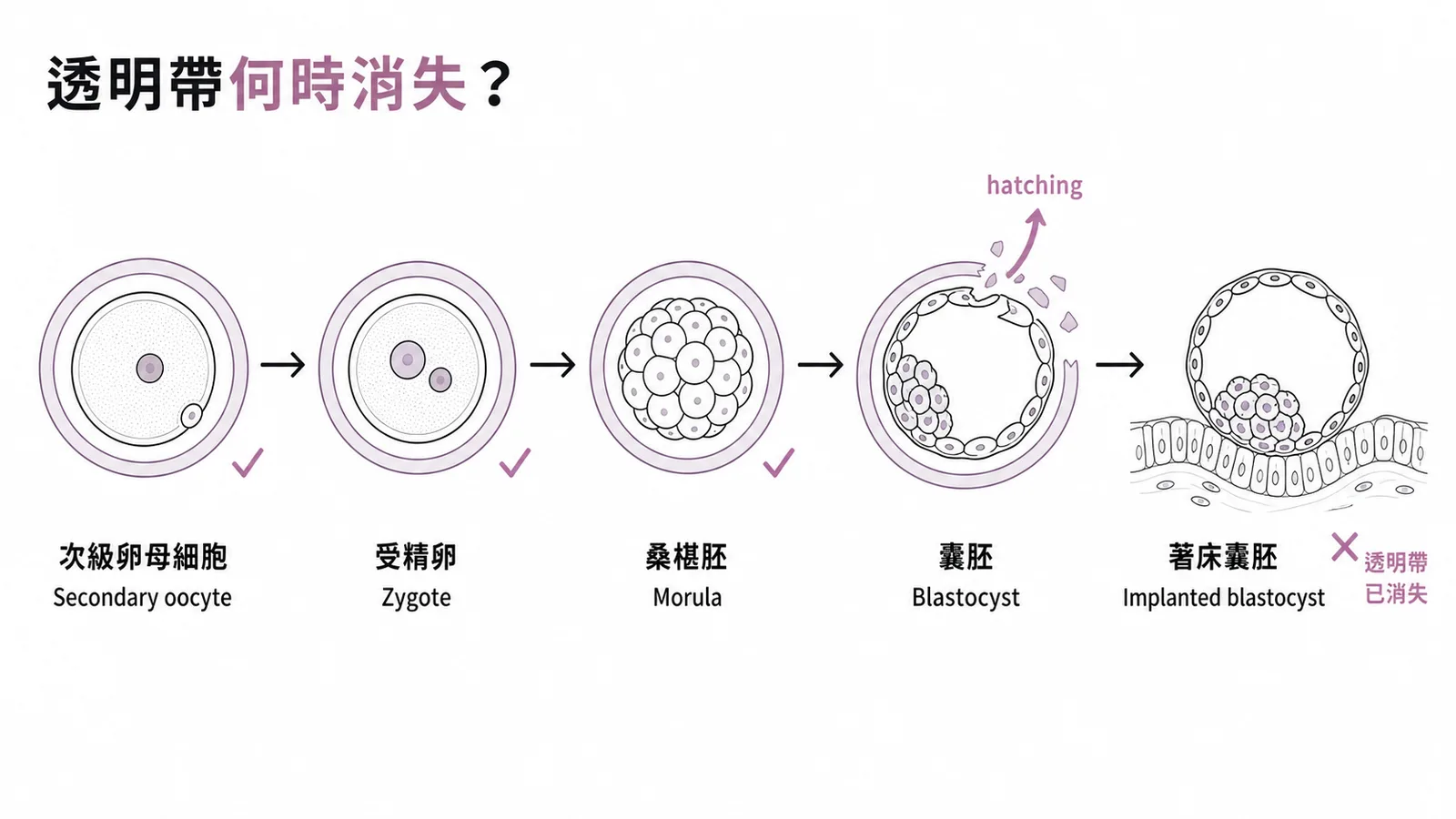 透明帶在胚胎發育時序中的存在與消失：從次級卵母細胞到囊胚hatching後消失，著床囊胚已無透明帶
