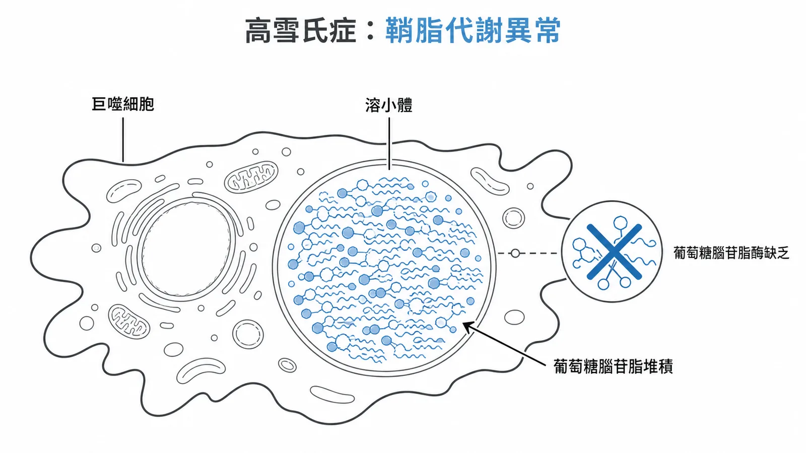 高雪氏症示意圖:巨噬細胞溶小體因缺乏 glucocerebrosidase 而堆積鞘脂
