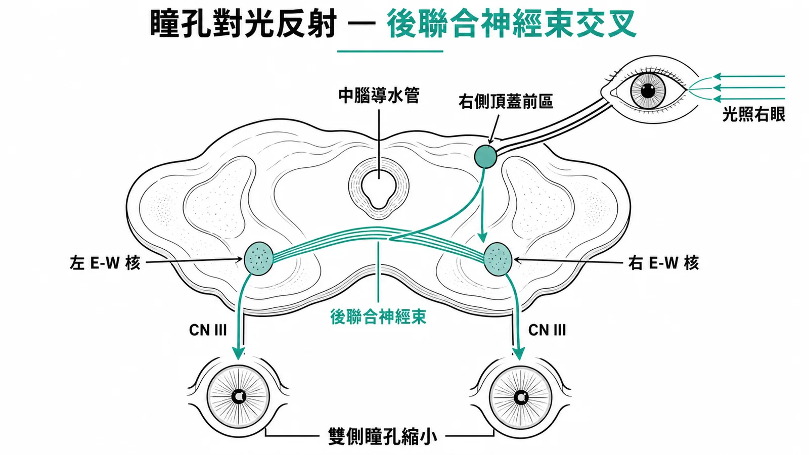 瞳孔對光反射經後聯合神經束交叉到對側E-W核