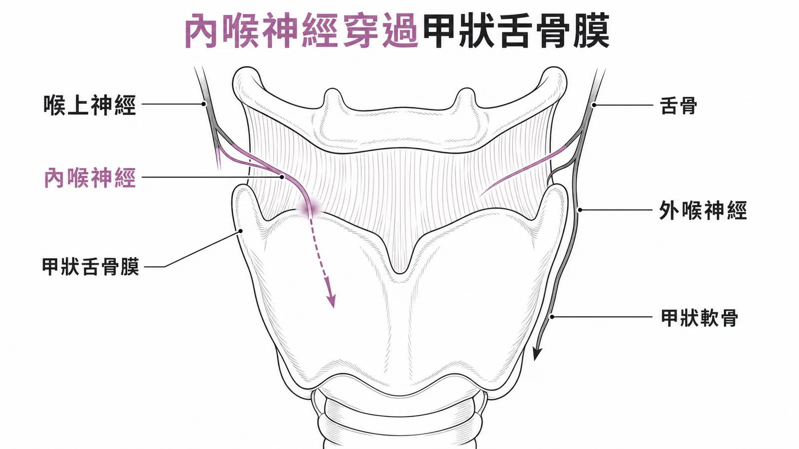 內喉神經穿過甲狀舌骨膜進入喉部的解剖路徑示意