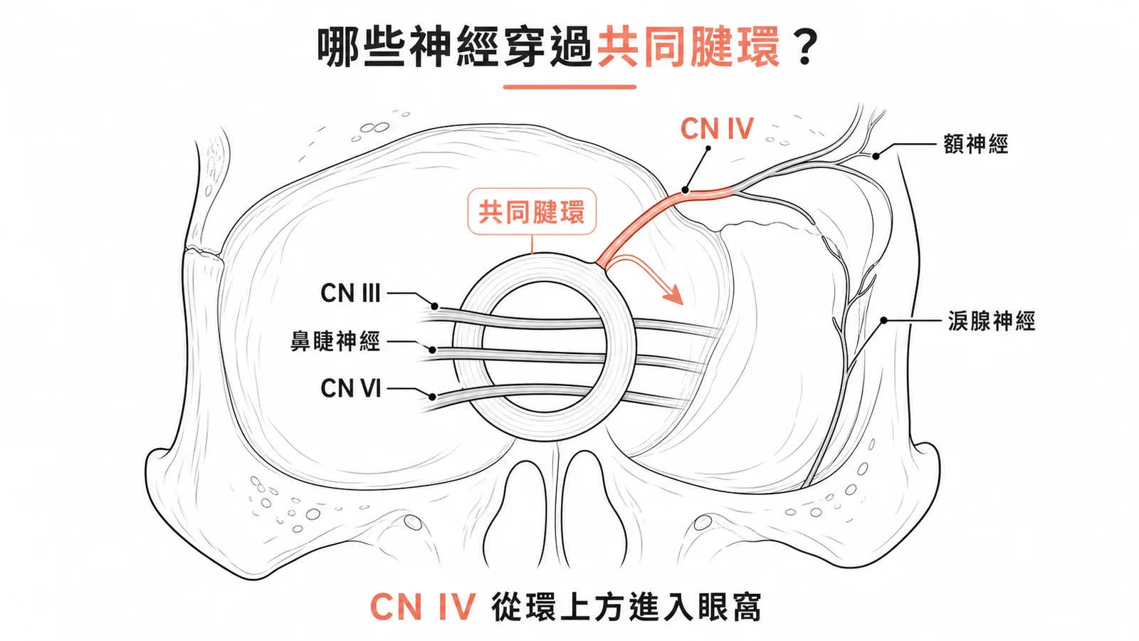 眼窩共同腱環示意:CN III、鼻睫神經、CN VI 穿過,CN IV 從上方繞過