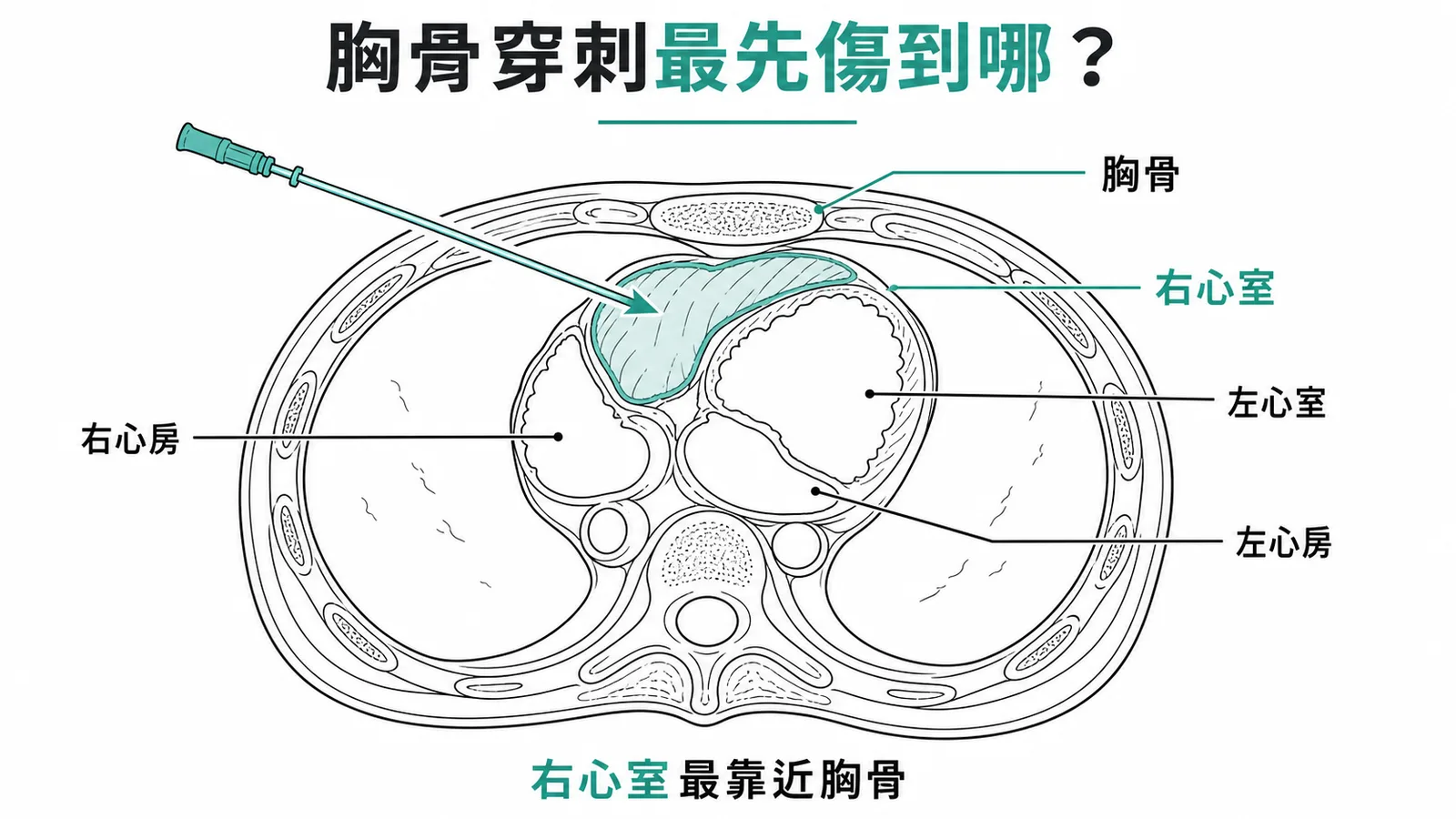 心臟橫切面示意:右心室位於最前方,胸骨左緣穿刺傷最先受損