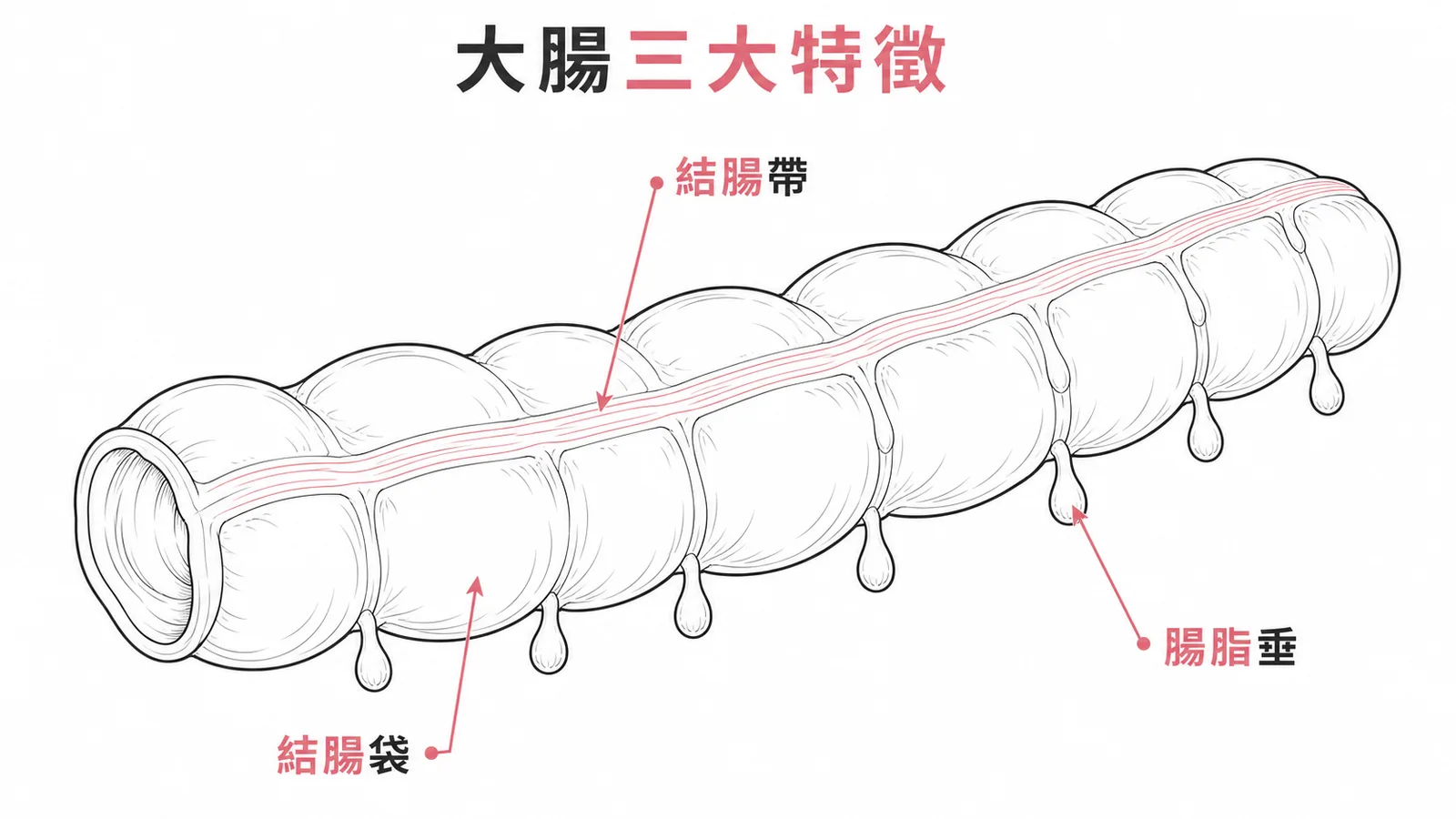 大腸三特徵：結腸帶、結腸袋、腸脂垂對比示意