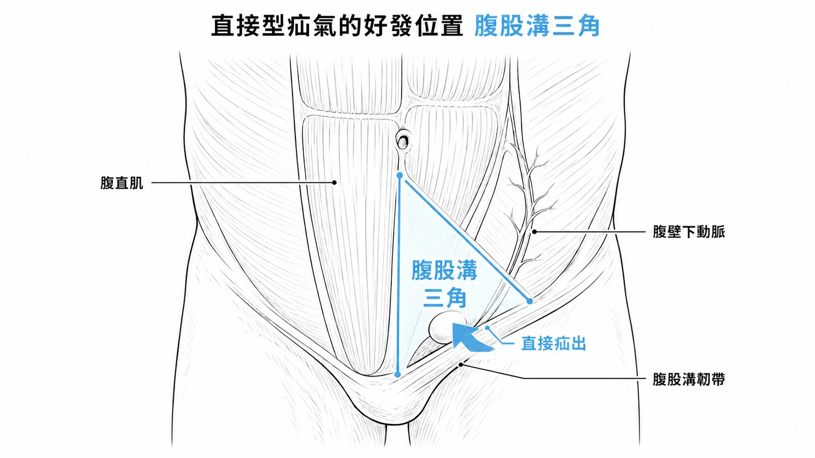腹股溝三角與直接型疝氣好發位置示意