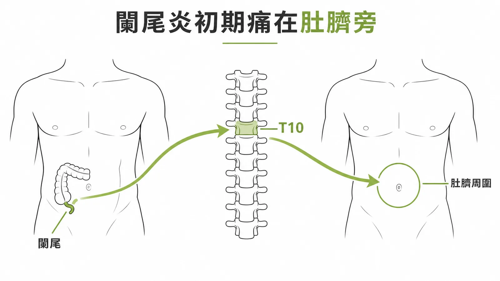 闌尾內臟痛經 T10 牽涉至肚臍周圍示意