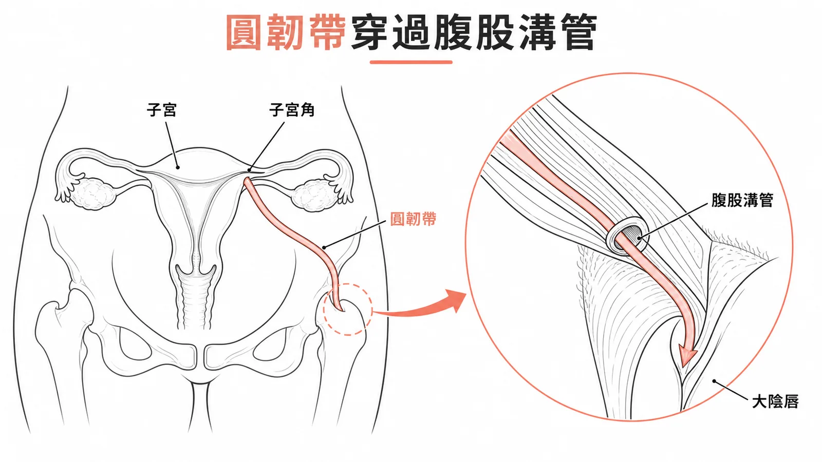 子宮圓韌帶穿過腹股溝管的路徑示意