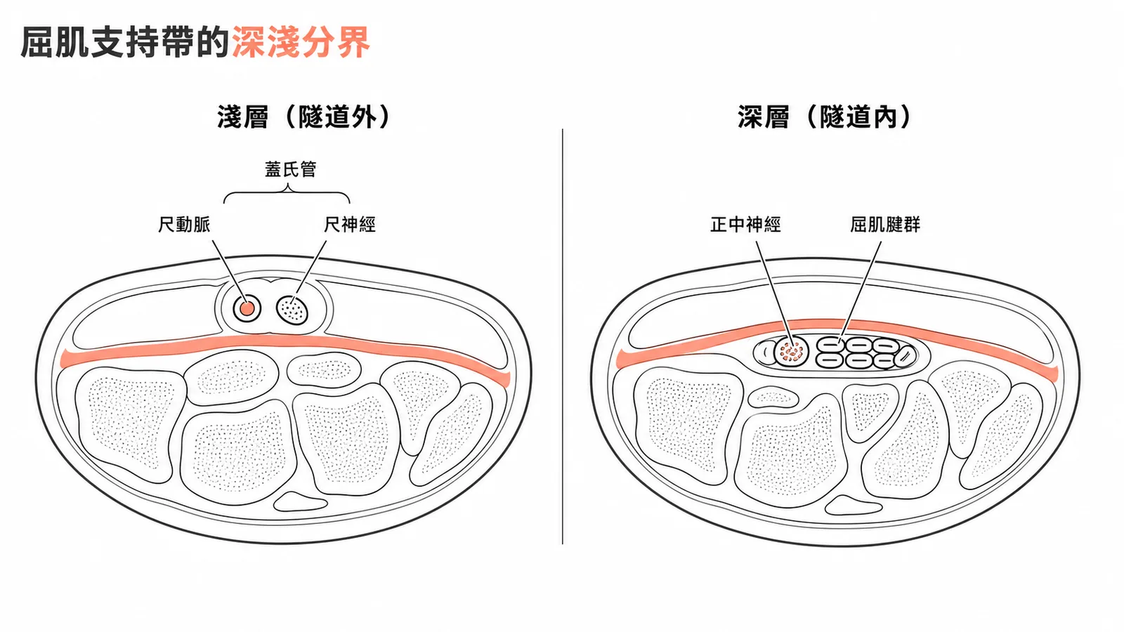 屈肌支持帶深淺層結構對比示意