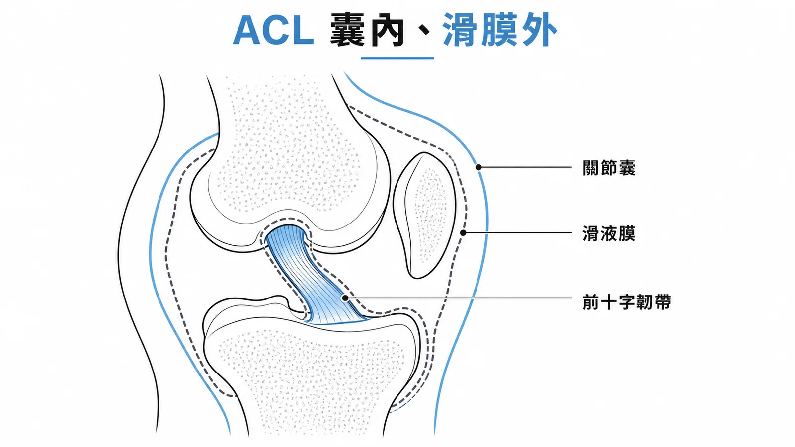 前十字韌帶:關節囊內但滑膜外的位置示意