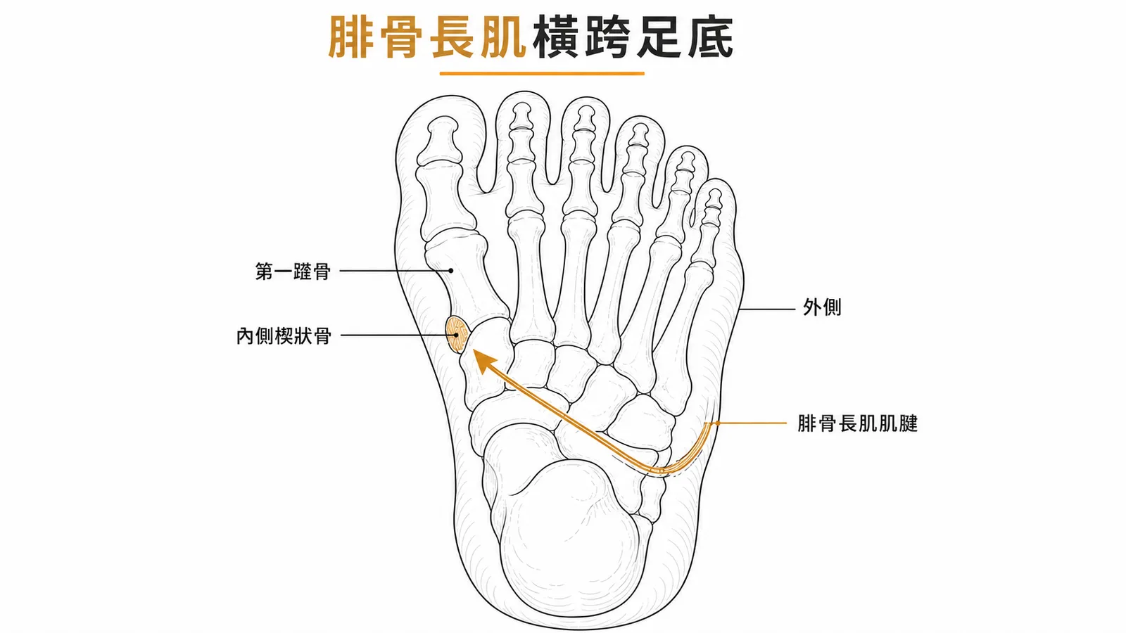 腓骨長肌肌腱從足部外側橫跨足底至第一蹠骨與內側楔狀骨的走向示意圖
