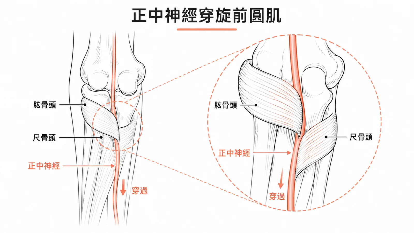 正中神經從旋前圓肌兩頭之間穿過的解剖示意圖