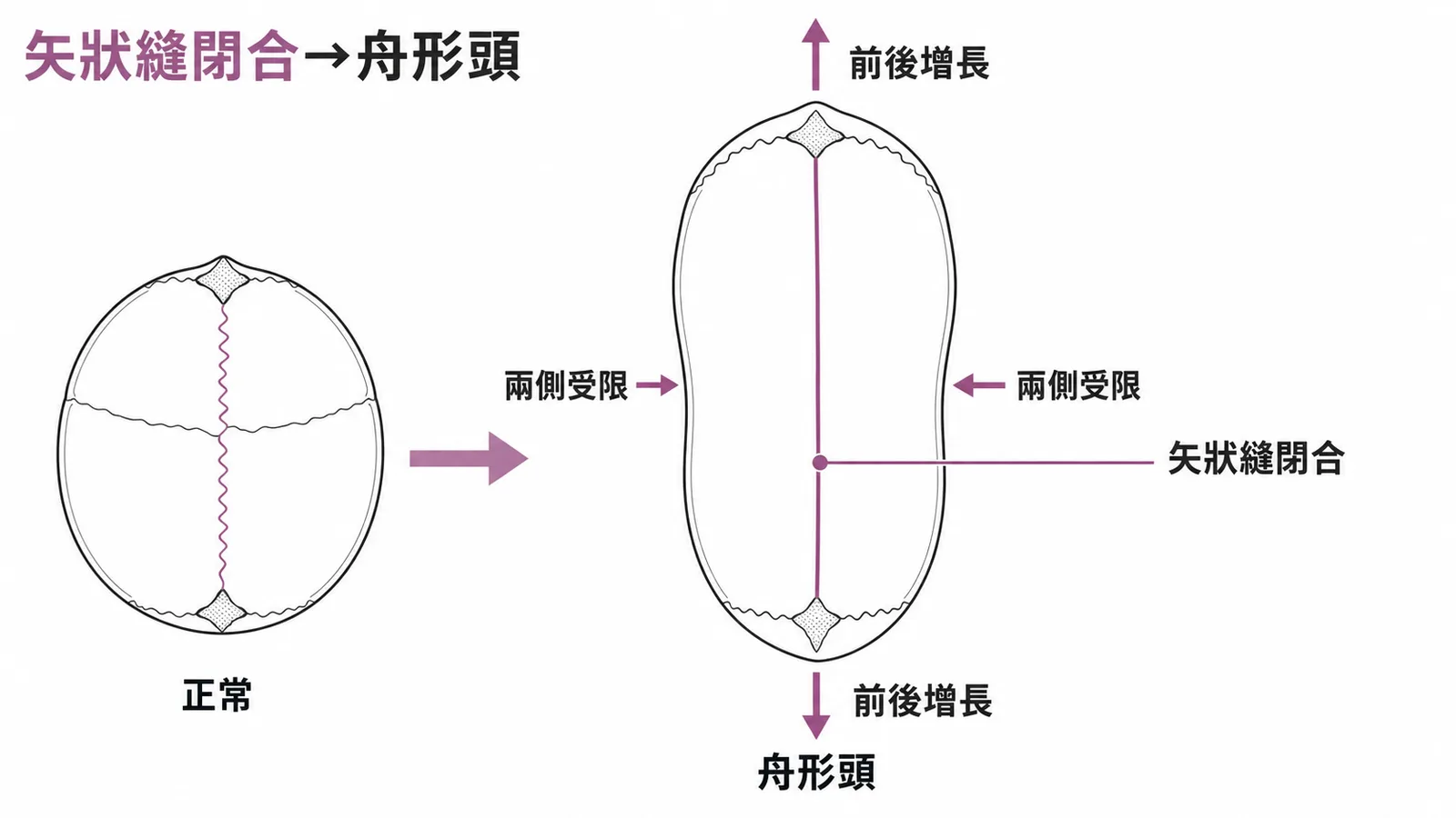 矢狀縫過早閉合導致舟形頭的正常與異常頭型對照圖