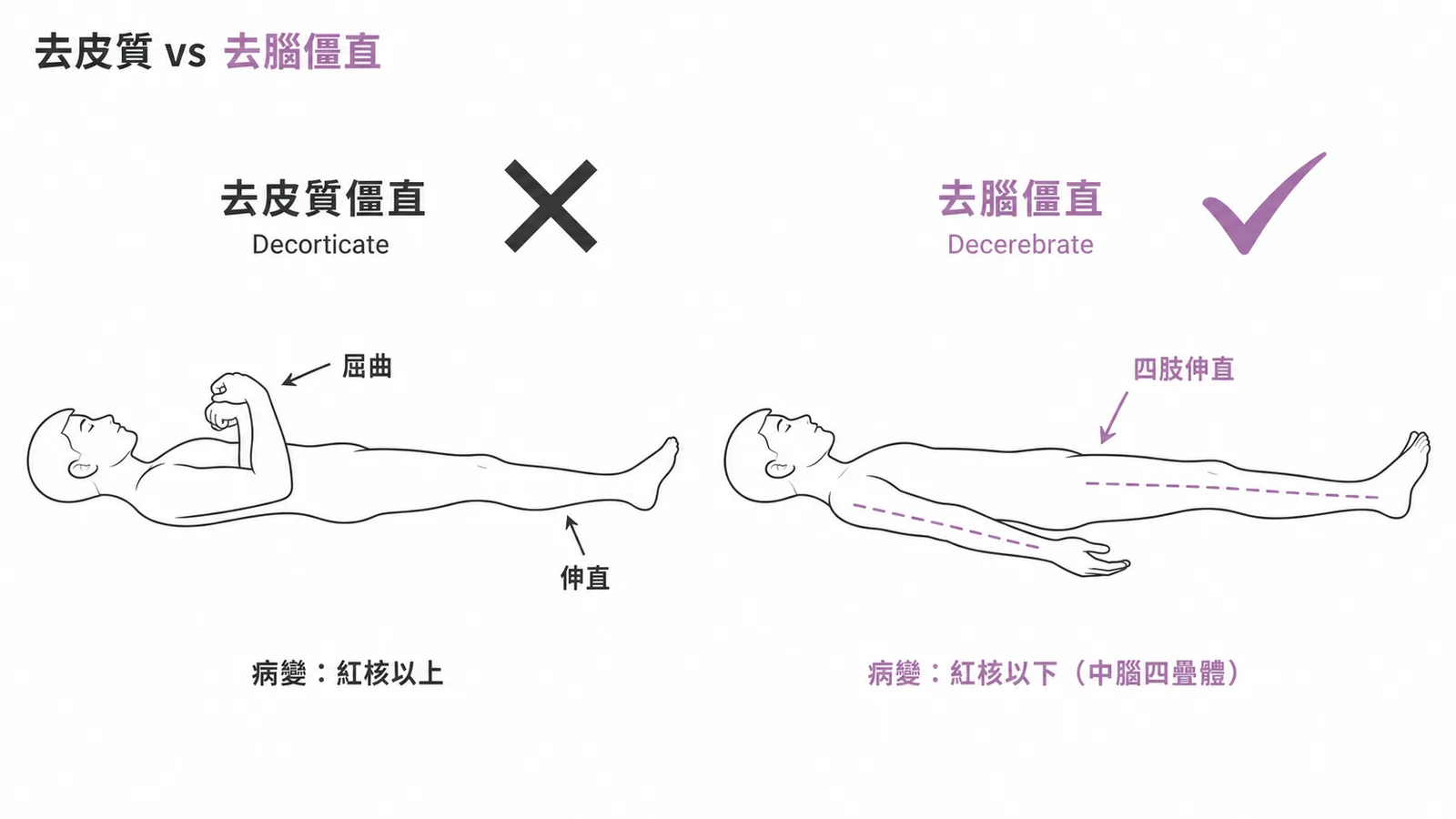 去皮質僵直與去腦僵直的姿勢對照圖