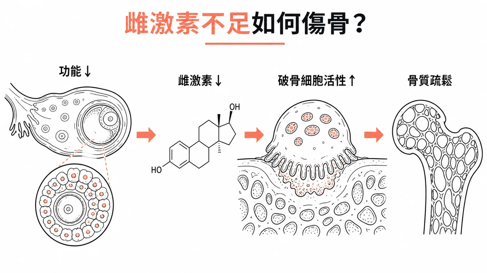 雌激素不足導致骨質疏鬆的機轉：卵巢功能下降→雌激素減少→破骨細胞活性增加→骨質流失
