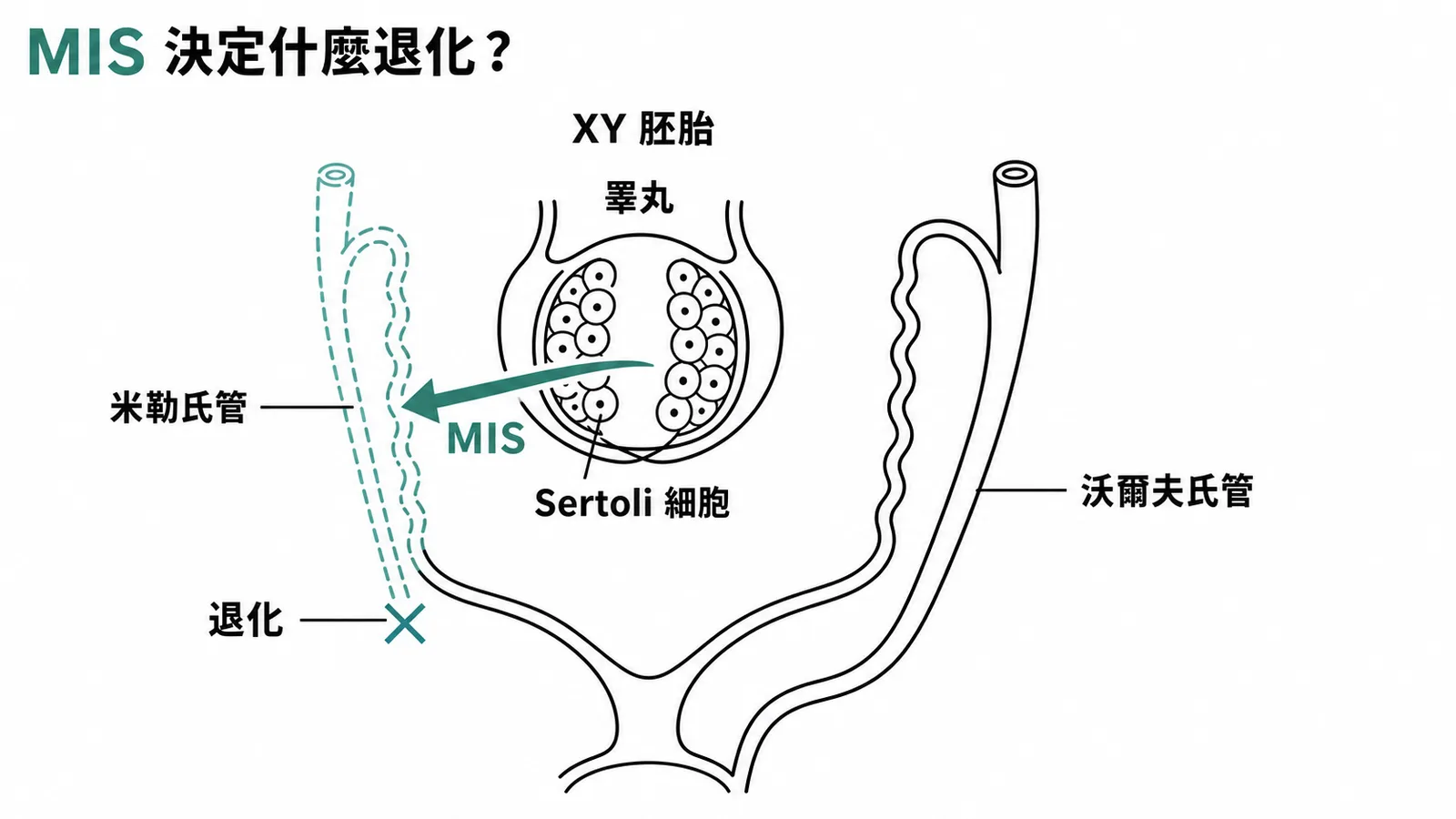 XY胚胎性別分化：Sertoli細胞分泌MIS使米勒氏管退化，沃爾夫氏管發育為男性生殖器官