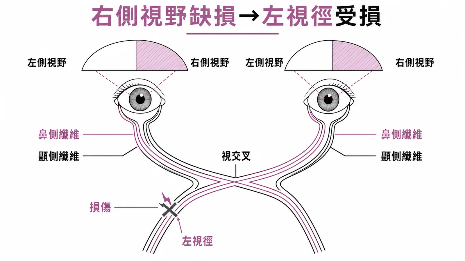右側視野缺損源自左視徑受損,鼻側纖維於視交叉交叉