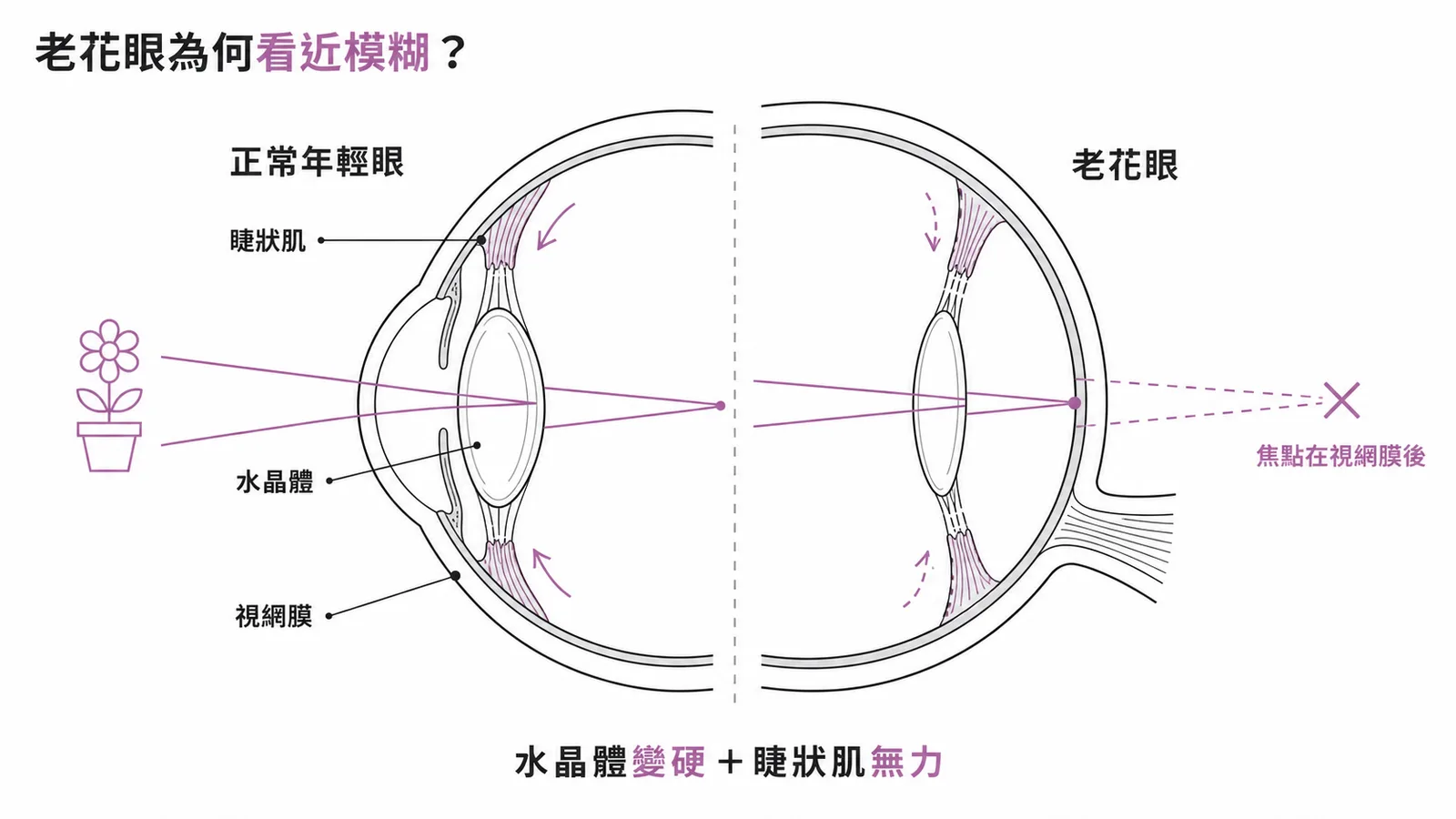 老花眼因水晶體變硬與睫狀肌無力導致看近模糊