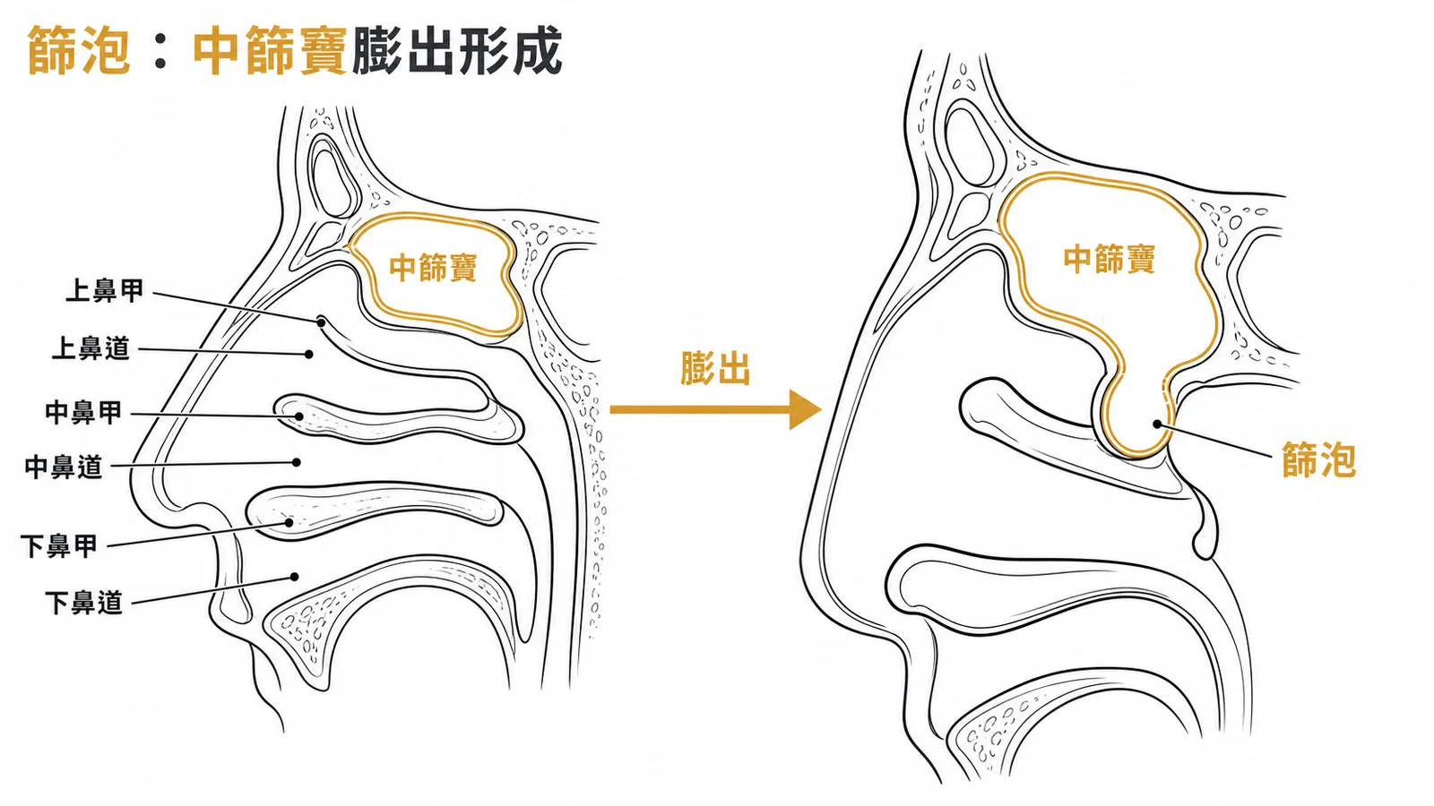 篩泡由中篩竇向中鼻道膨出形成