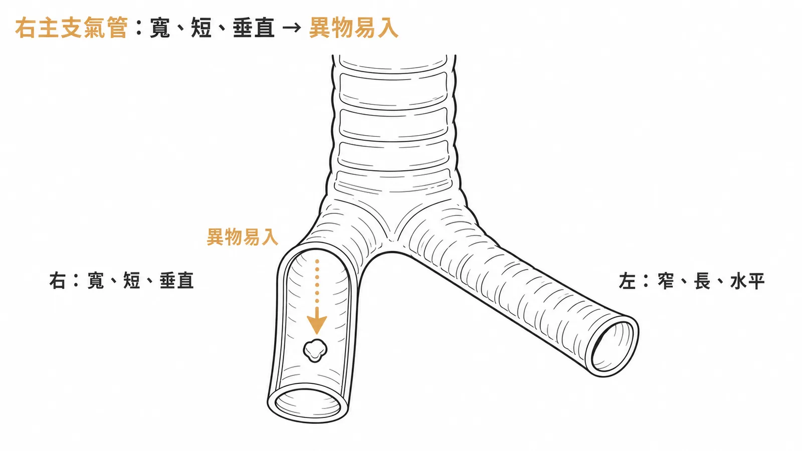 右主支氣管比左側更寬更短更垂直所以異物容易掉入右側