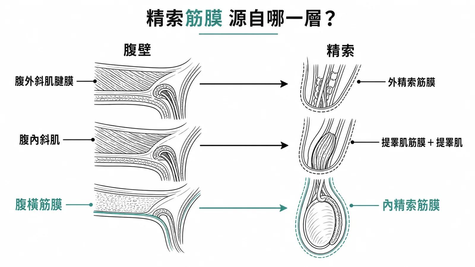 精索三層筋膜對應腹壁三層結構