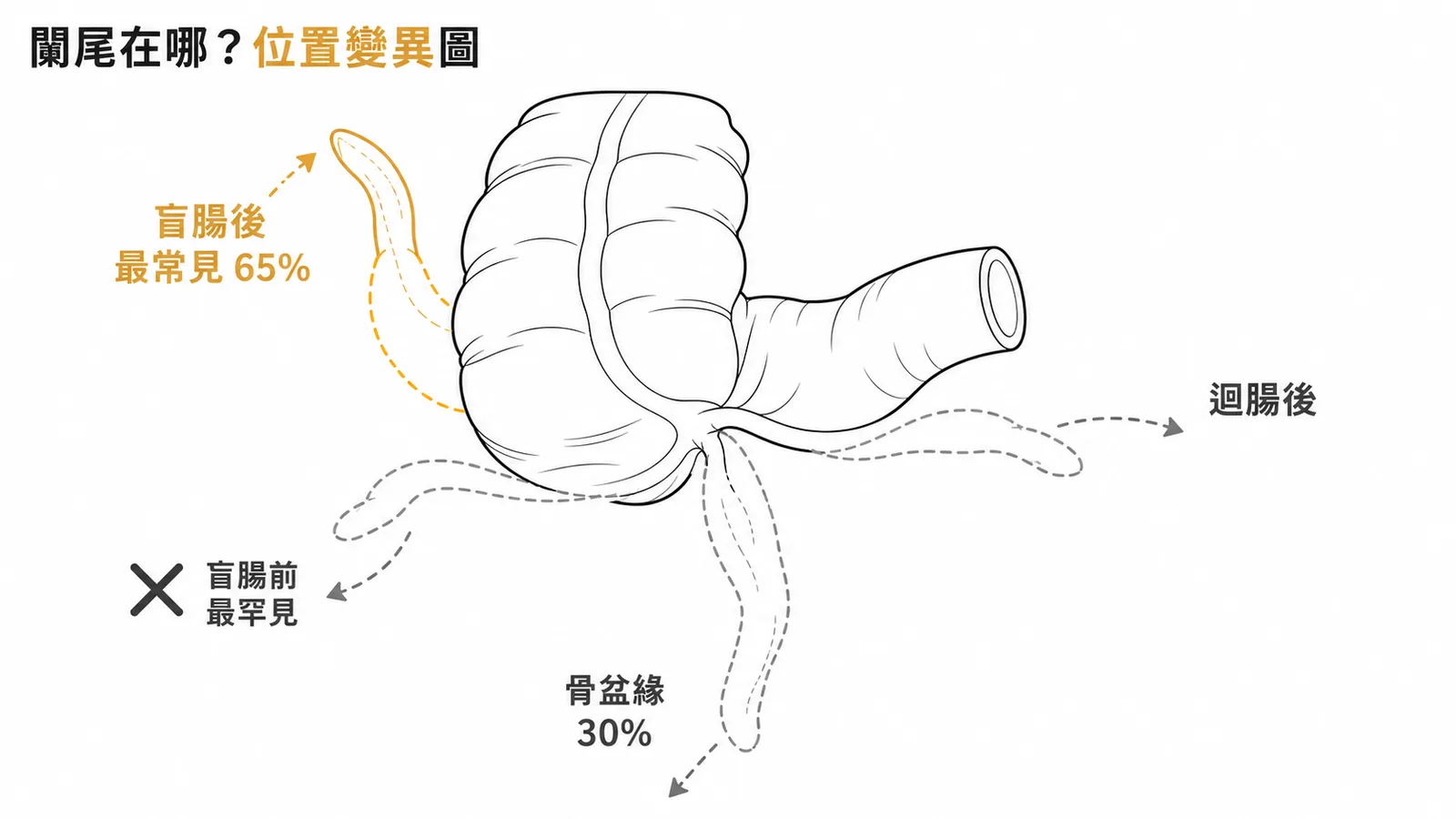 闌尾位置變異：盲腸後最常見65%、盲腸前最罕見