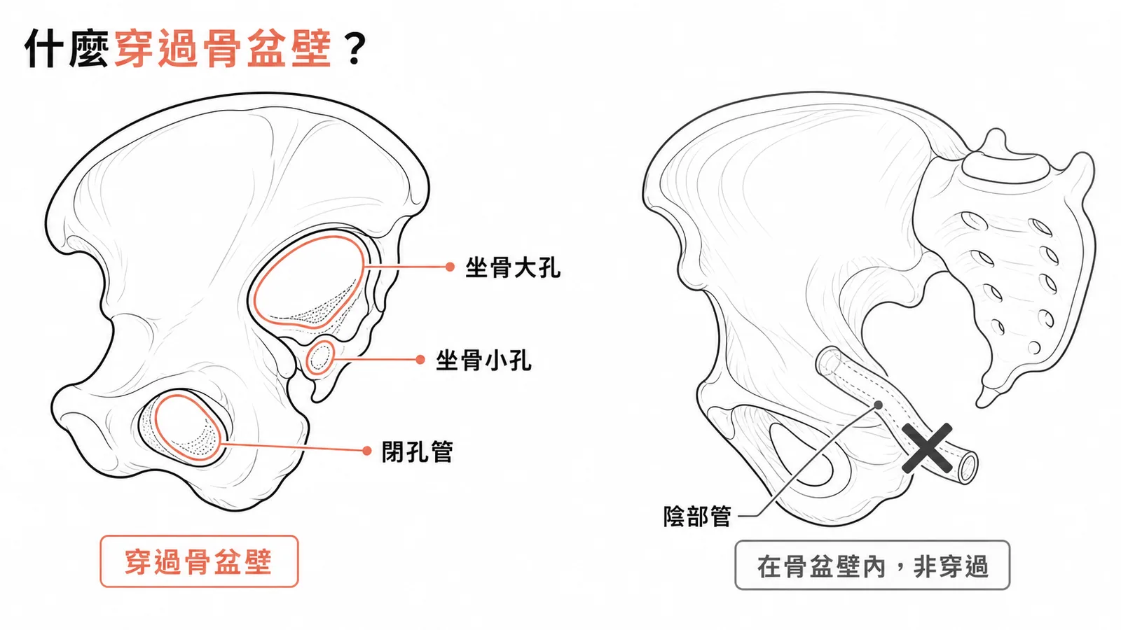 骨盆壁孔洞:閉孔管、坐骨大孔、坐骨小孔穿過;陰部管在壁內