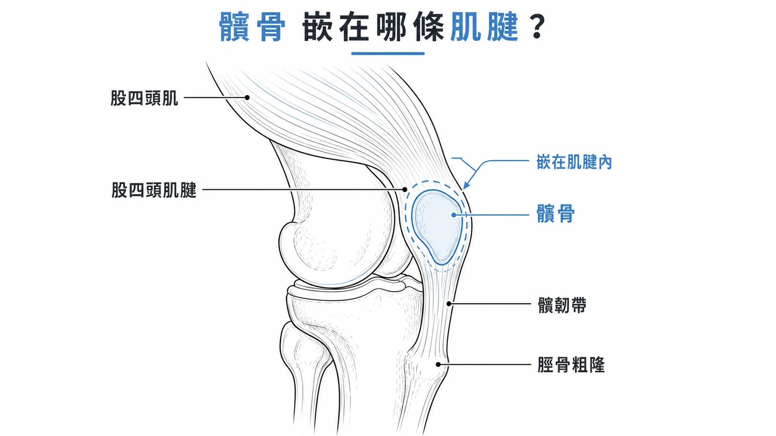 髕骨嵌在股四頭肌腱內,為人體最大籽骨