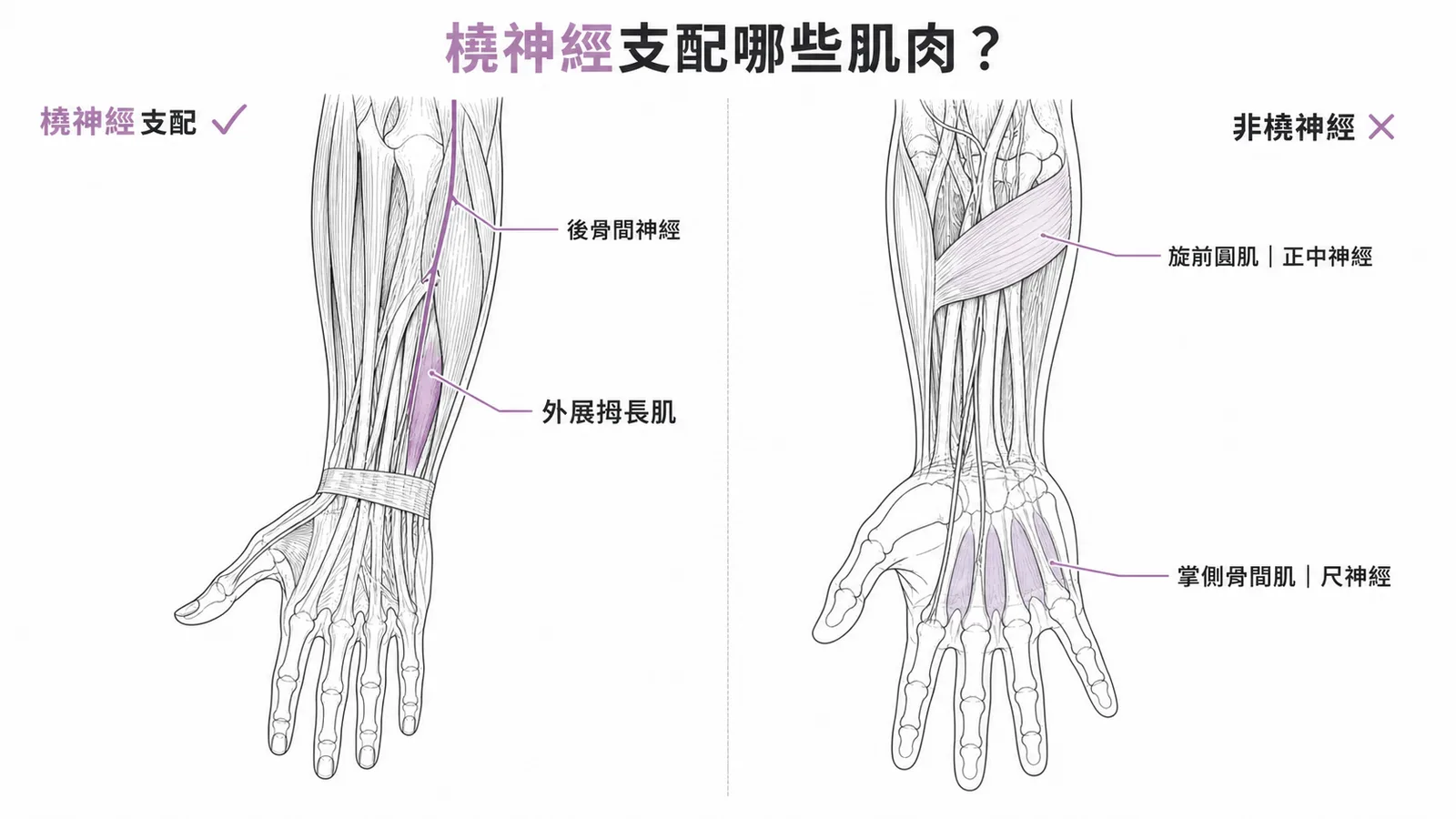橈神經支配前臂後區伸肌群與非橈神經支配肌肉的對照示意圖