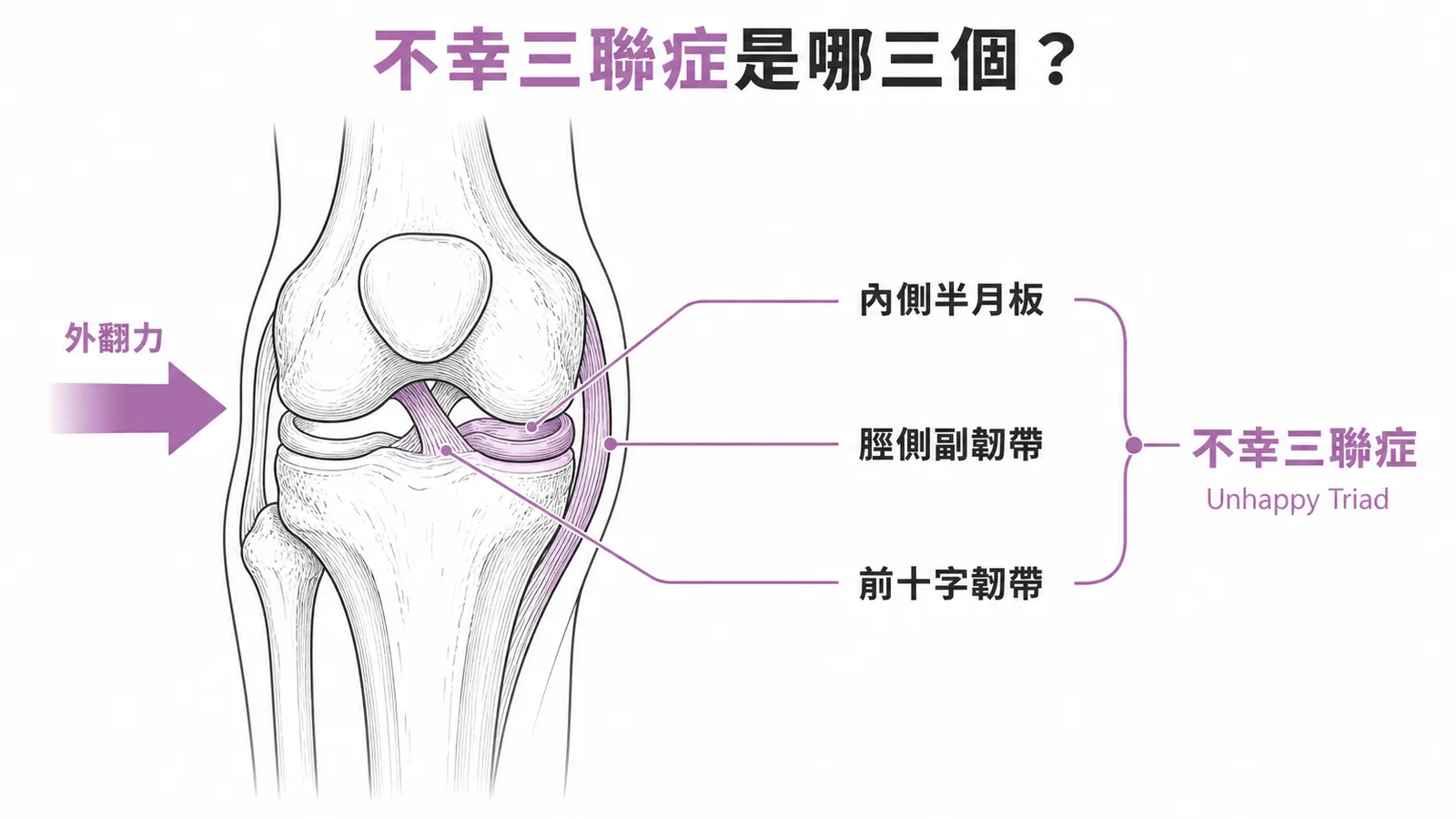 膝關節不幸三聯症示意圖:內側半月板、脛側副韌帶與前十字韌帶