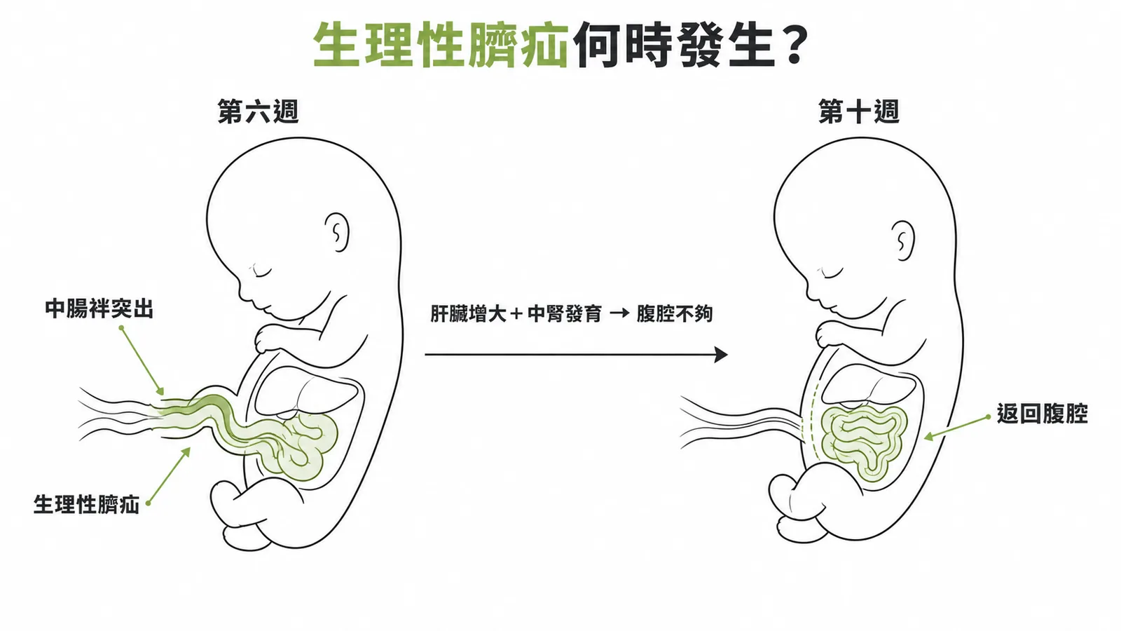 生理性臍疝第六週發生與第十週返回的時間軸示意圖