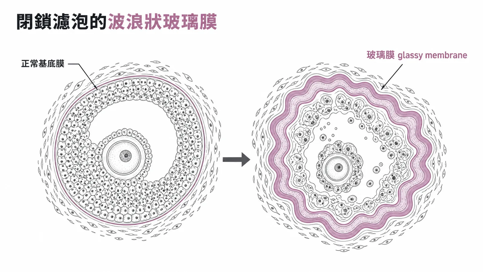閉鎖濾泡特徵：基底膜增厚形成波浪狀玻璃膜（glassy membrane）