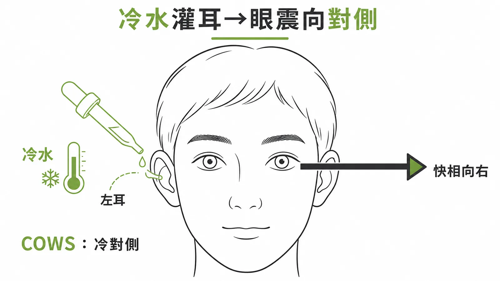 冷水灌耳試驗COWS原則：冷水注入左耳，眼震快相指向對側（右側）