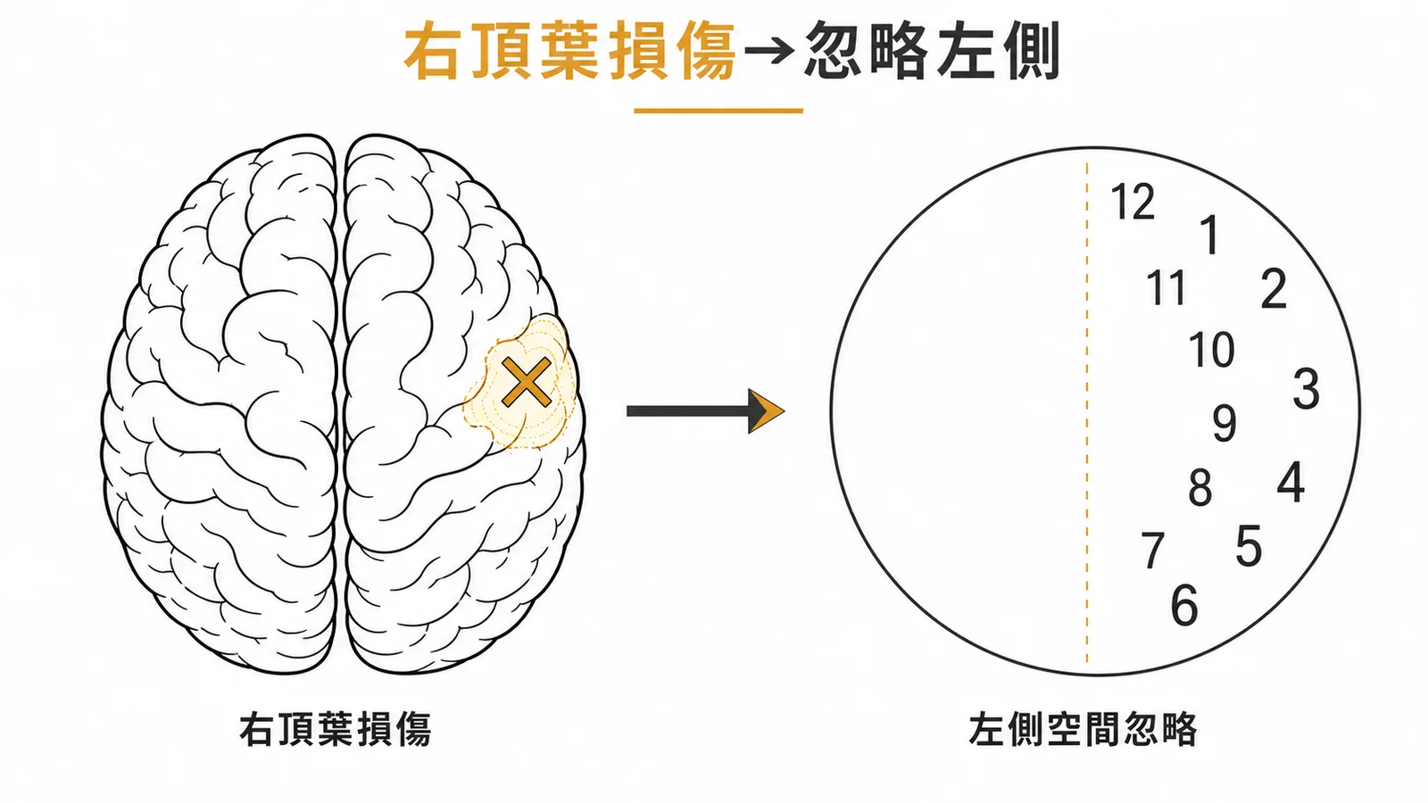 右頂葉損傷導致左側空間忽略，時鐘繪圖數字全擠在右半邊