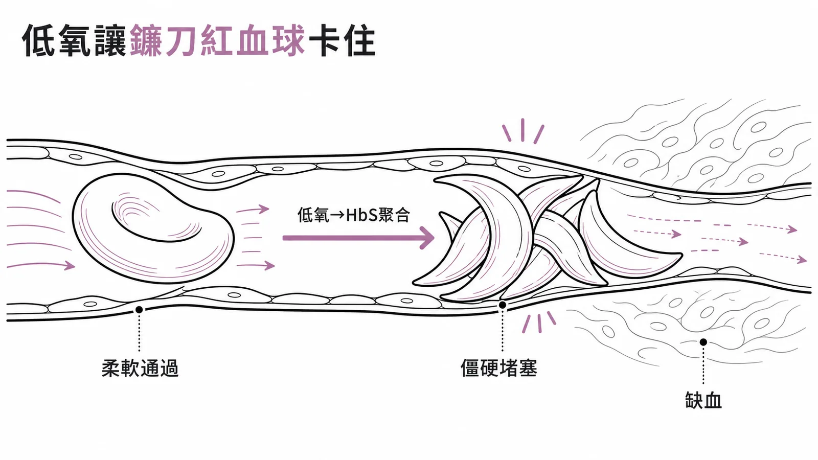 鐮刀型紅血球在低氧下變形阻塞微血管示意圖