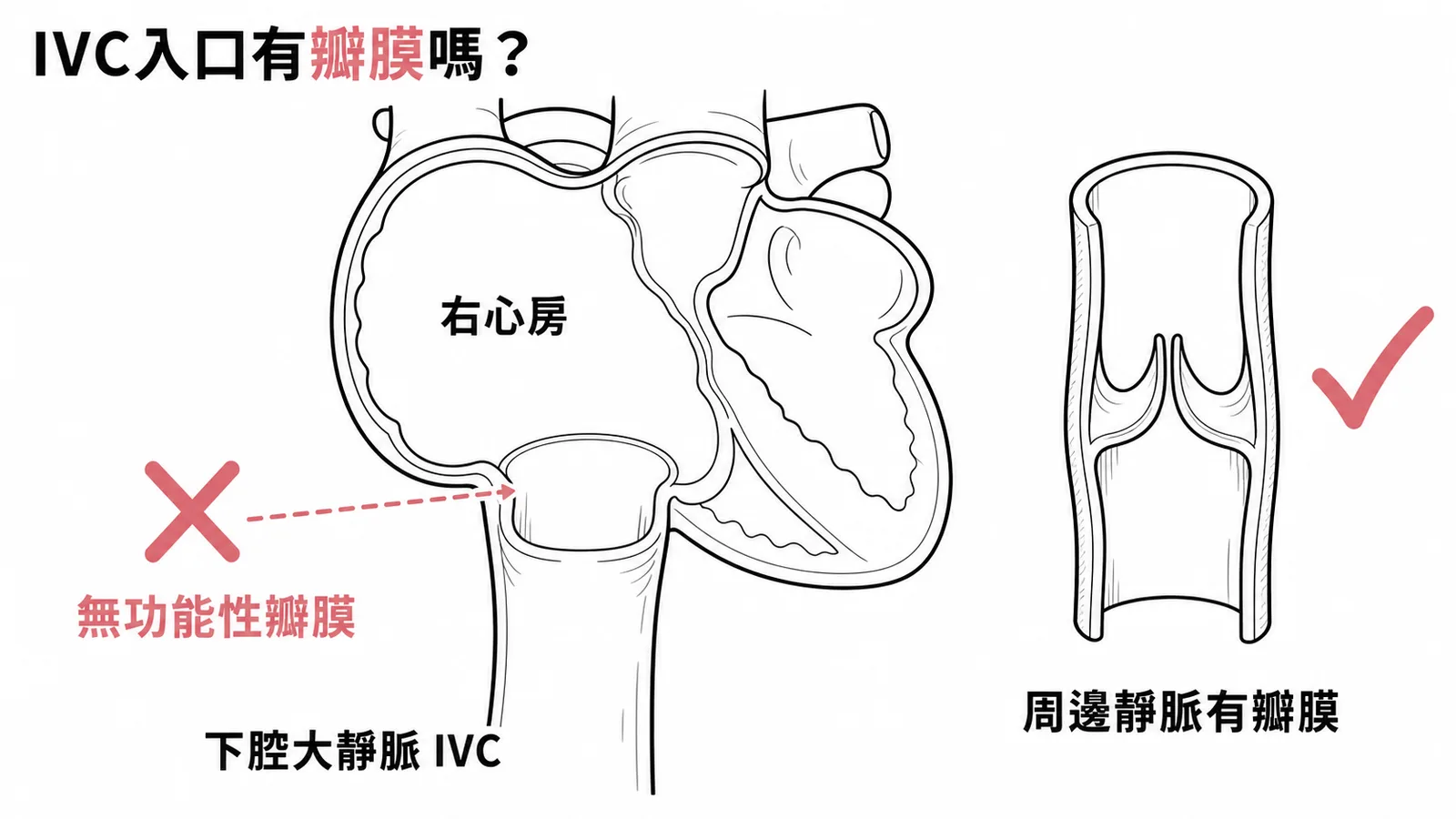 下腔大靜脈入口無功能性瓣膜與周邊靜脈有瓣膜對比