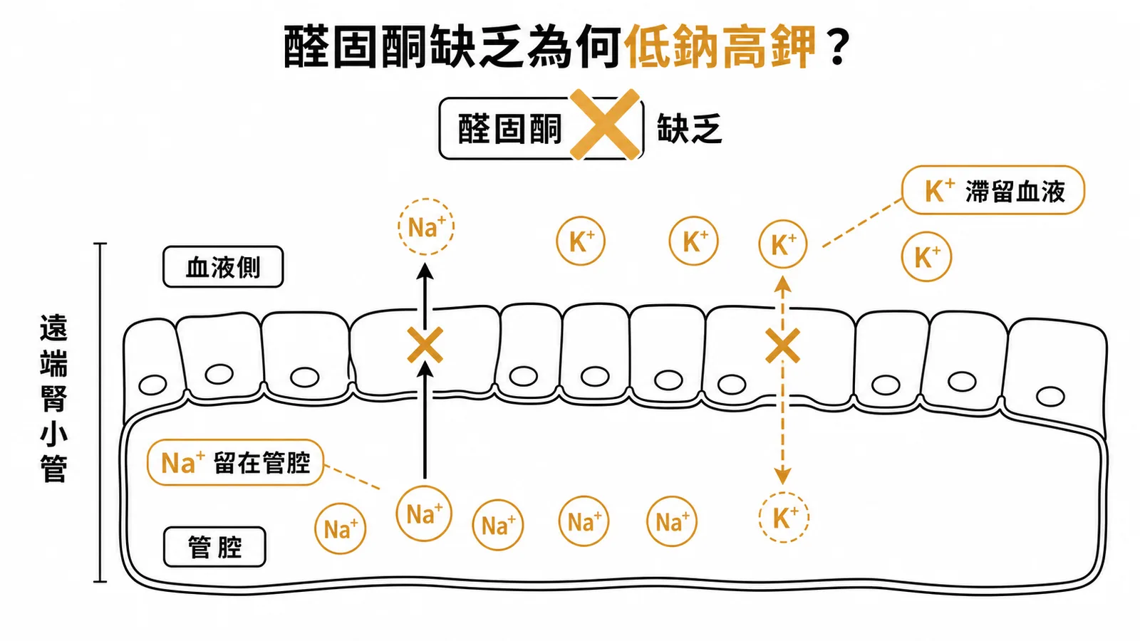 醛固酮缺乏時遠端腎小管無法重吸收鈉與分泌鉀的示意圖