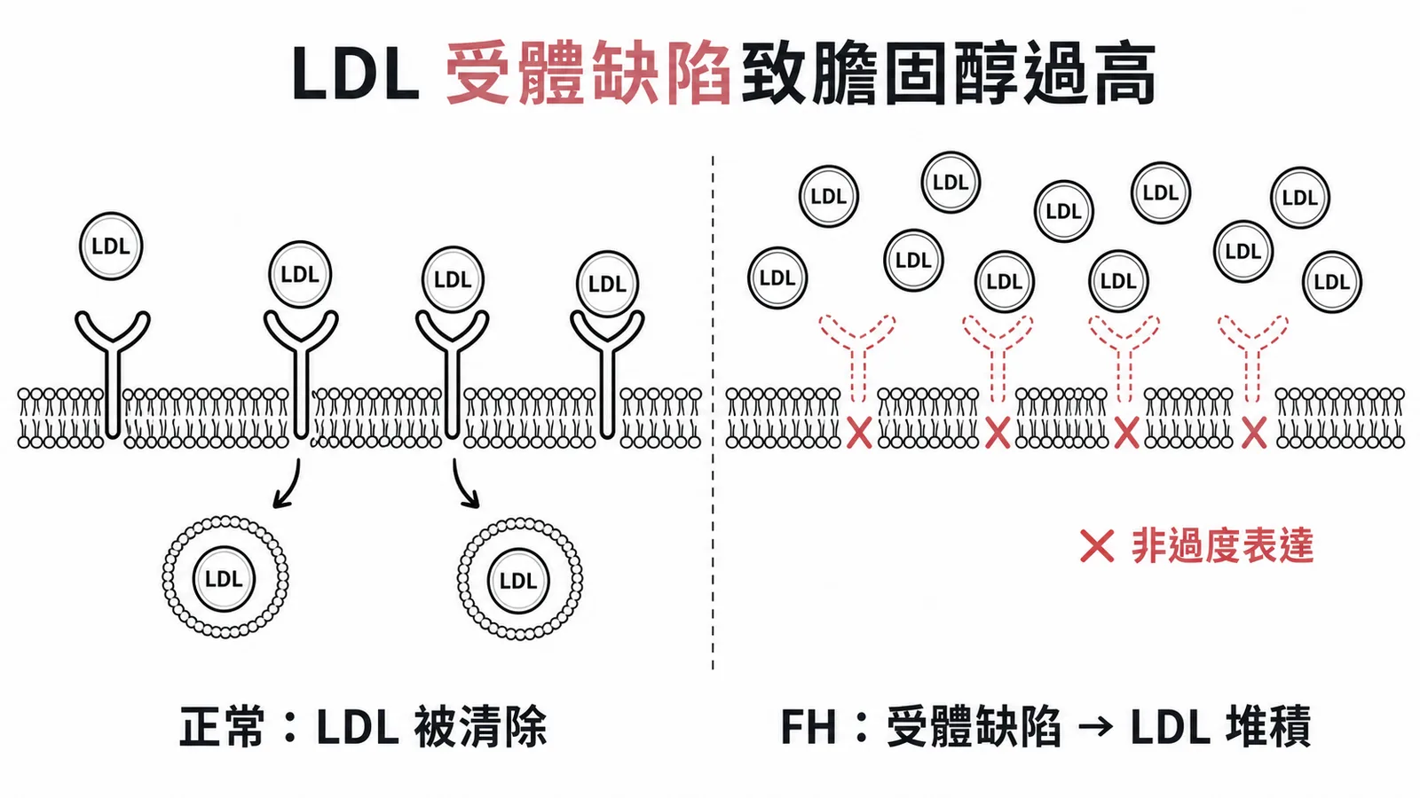 家族性高膽固醇症因LDL受體缺陷導致LDL無法被細胞清除而堆積
