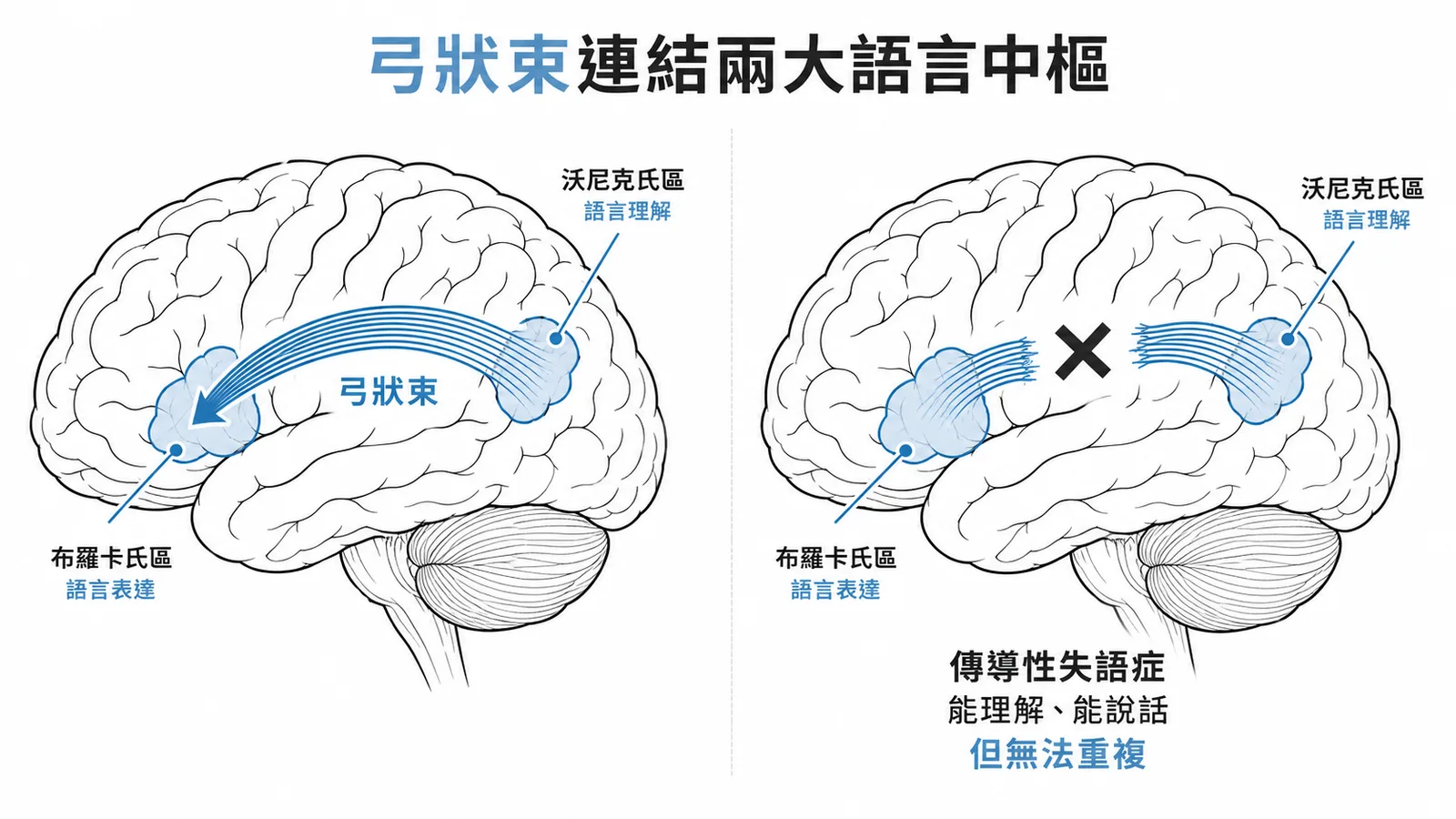 弓狀束連結布羅卡氏區與沃尼克氏區示意圖