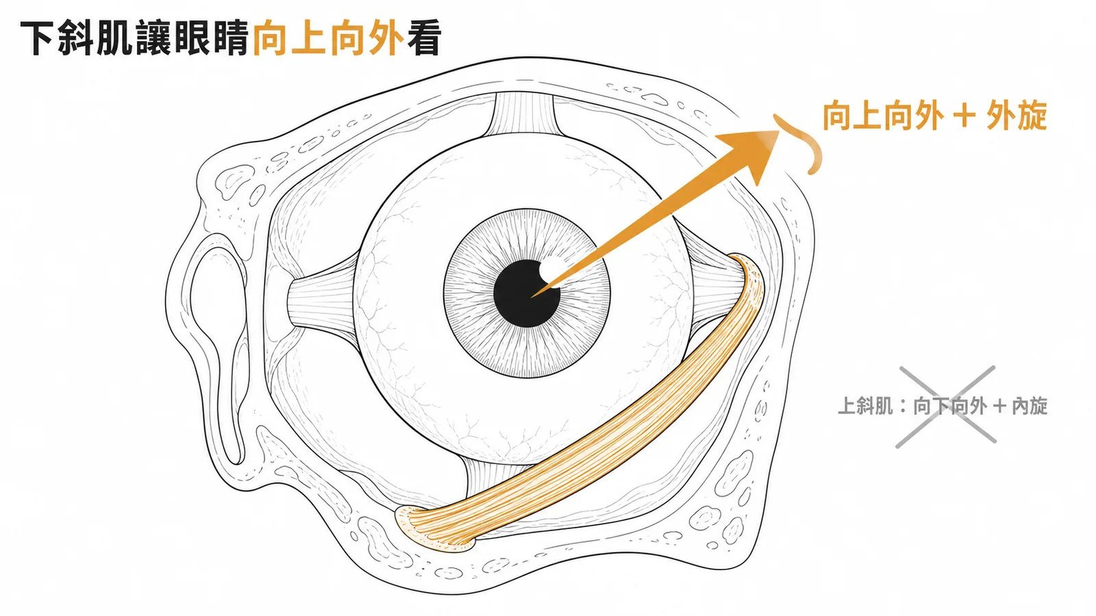 下斜肌讓眼球向上向外轉動及外旋示意圖