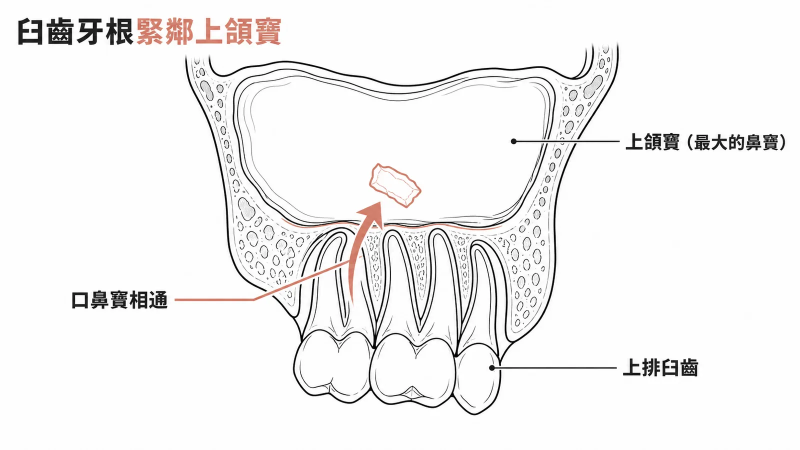 臼齒牙根與上頷竇底部緊鄰的冠狀切面示意圖