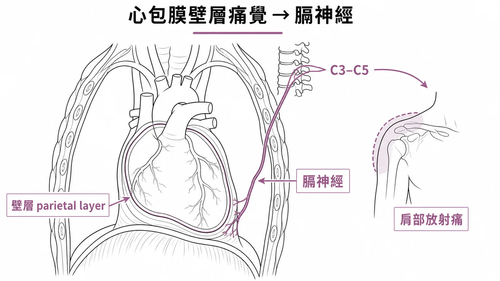 膈神經沿心包膜壁層走行傳遞痛覺並放射至肩部