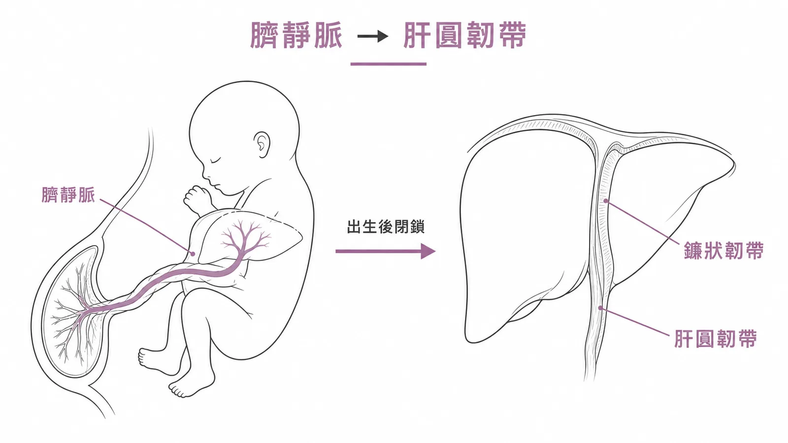 胎兒臍靜脈出生後閉鎖成為肝圓韌帶位於鐮狀韌帶游離緣