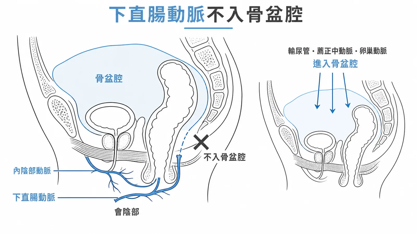 下直腸動脈不入骨盆腔——骨盆矢狀切面示意圖,標示下直腸動脈走會陰路徑