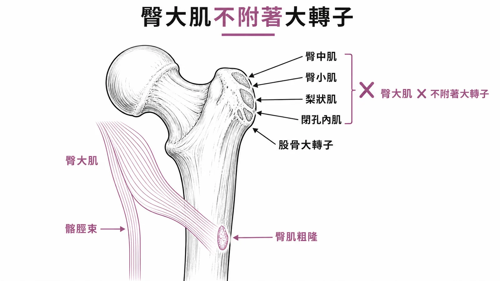 臀大肌不附著大轉子——股骨近端肌肉附著點示意圖