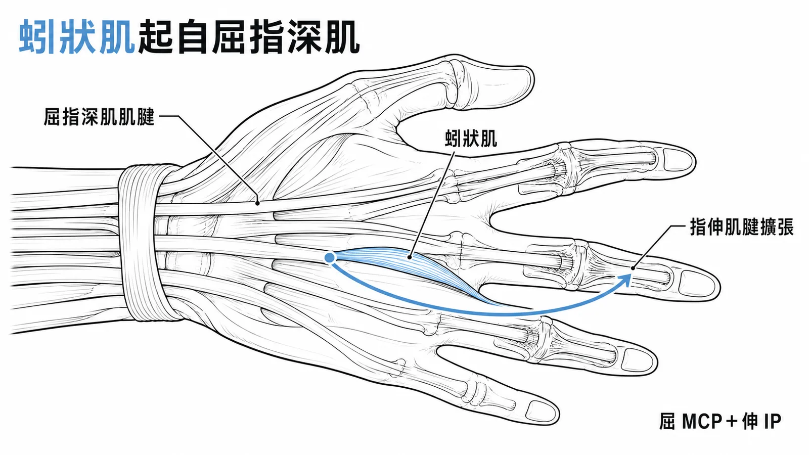 蚓狀肌起自屈指深肌——手部蚓狀肌走行示意圖,從FDP肌腱到extensor expansion
