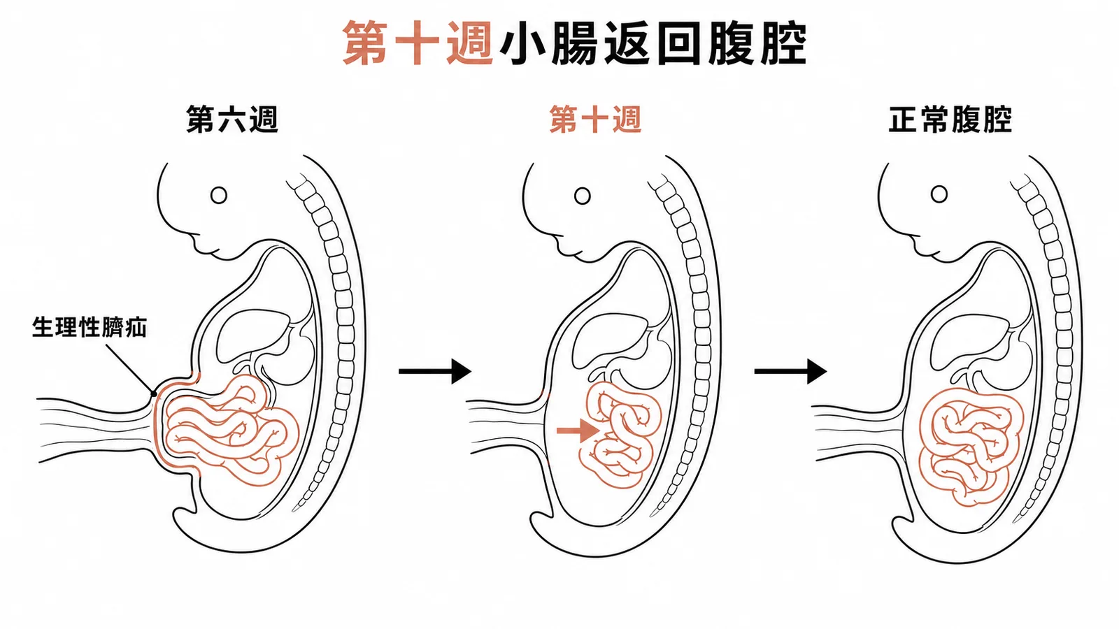 小腸生理性臍疝時間線:第六週突出至臍帶根部,第十週返回腹腔