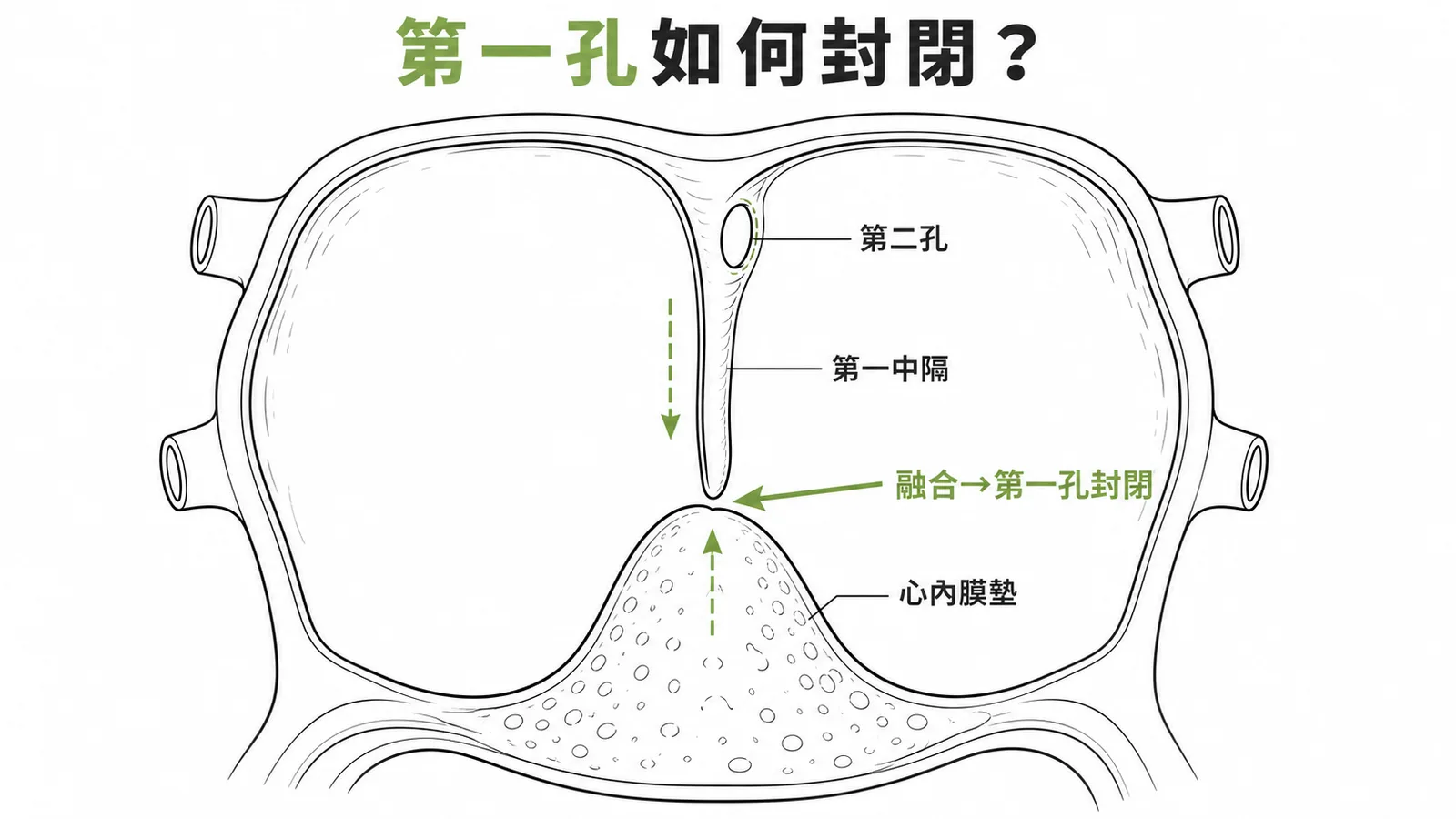 心房間隔發育示意圖:第一中隔與心內膜墊融合封閉第一孔