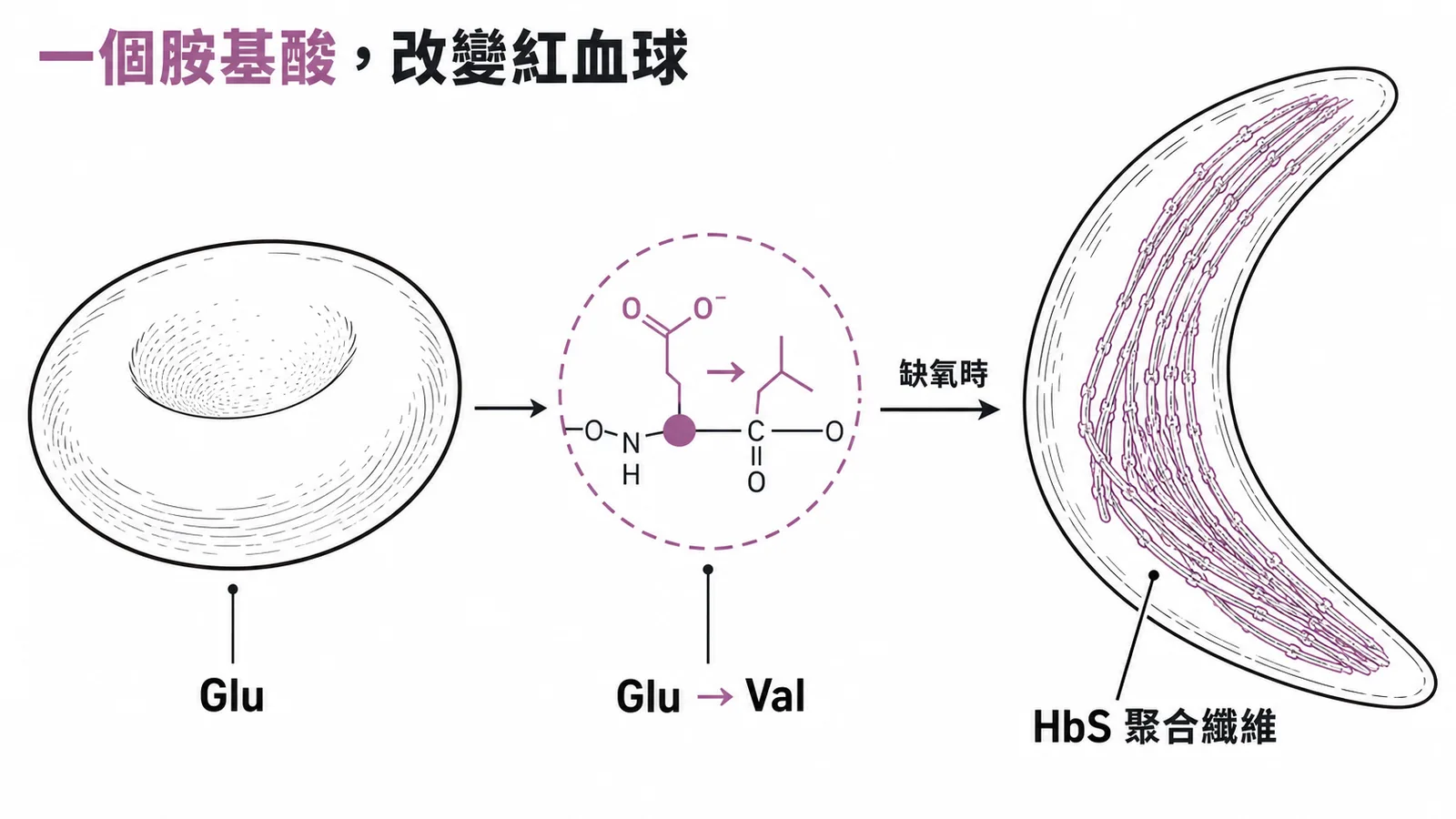 鐮形血球貧血症：β血球蛋白Glu→Val點突變導致HbS聚合