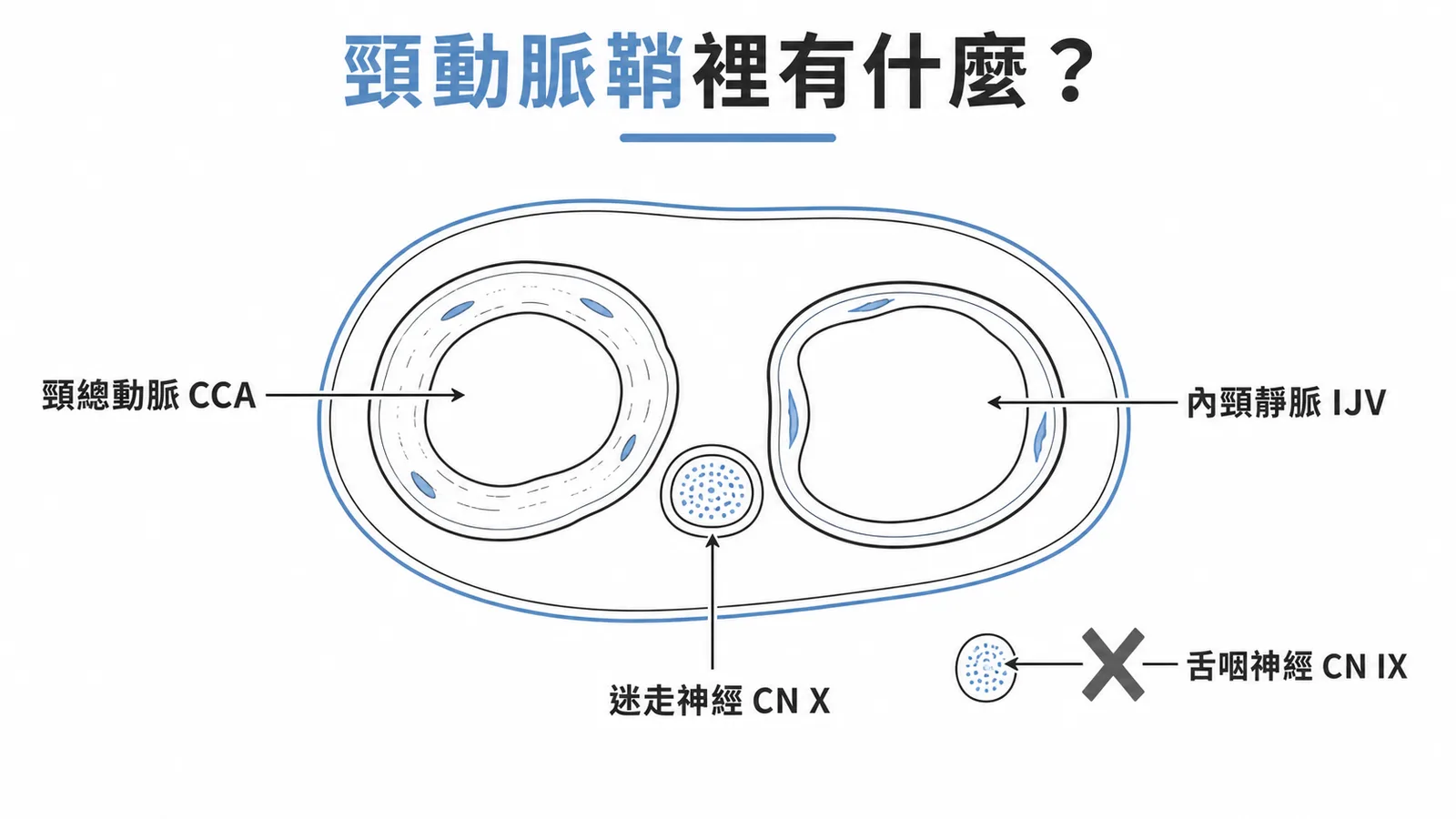 頸動脈鞘橫切面示意：內含頸總動脈、內頸靜脈、迷走神經，舌咽神經位於鞘外